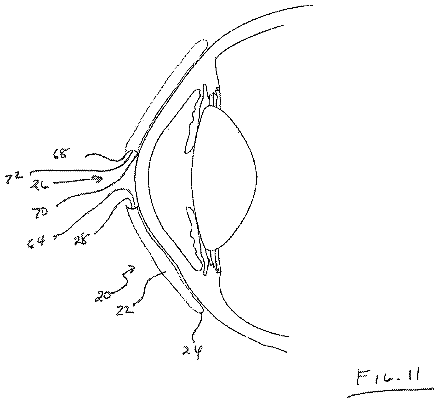 Patent US12105359 Figure 7 – Tear shaping for refractive correction