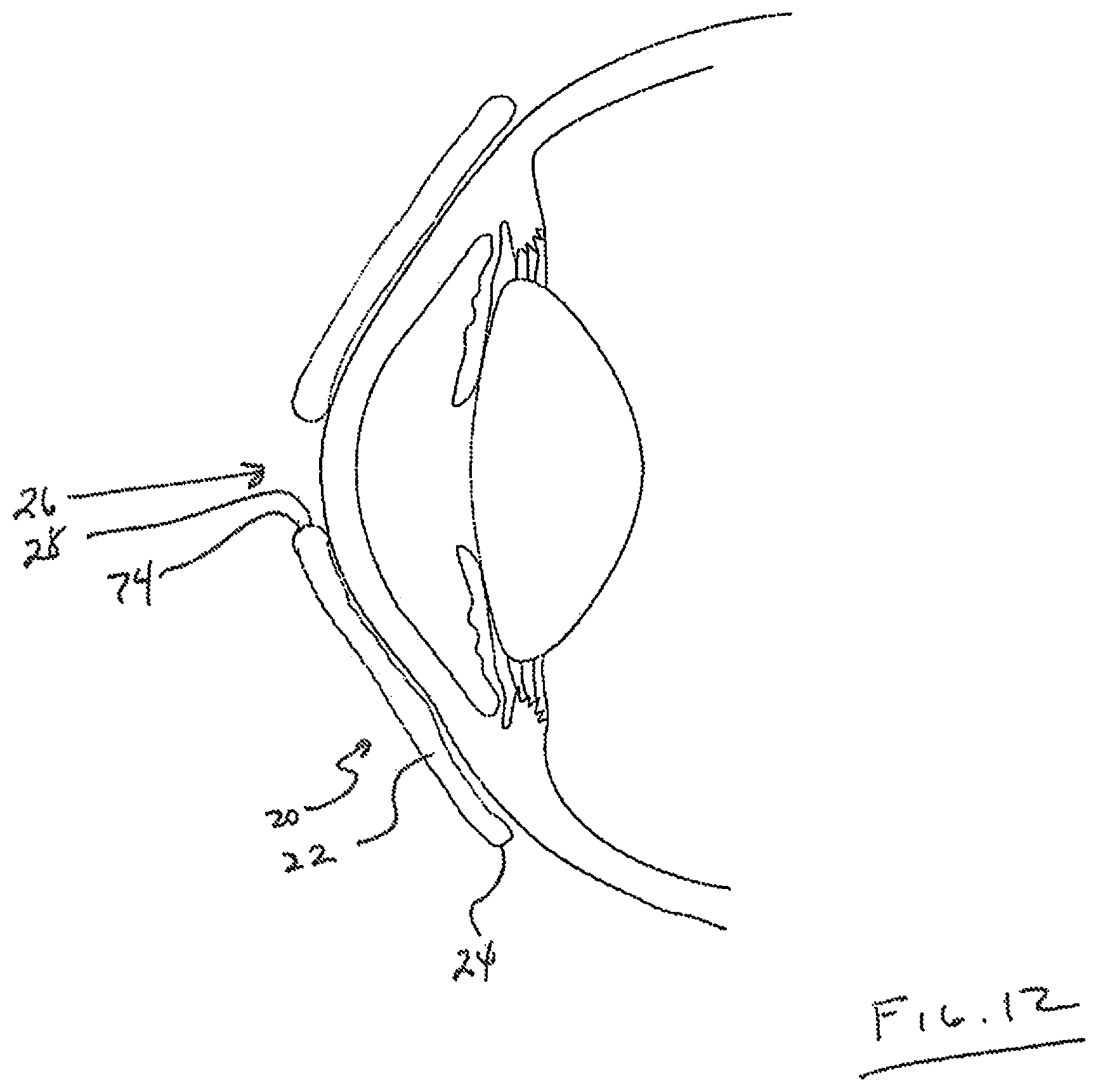 Patent US12105359 Figure 8 – Tear shaping for refractive correction