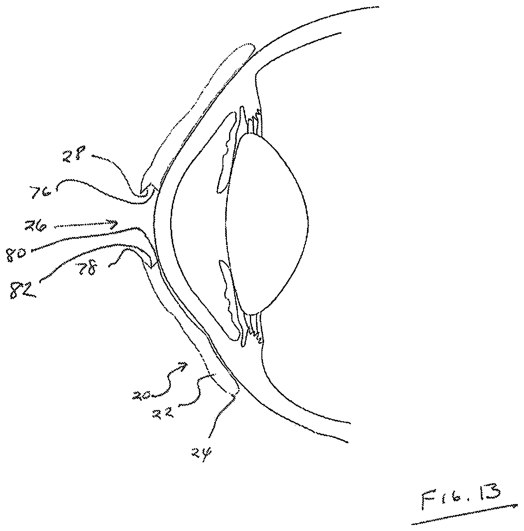 Patent US12105359 Figure 9 – Tear shaping for refractive correction