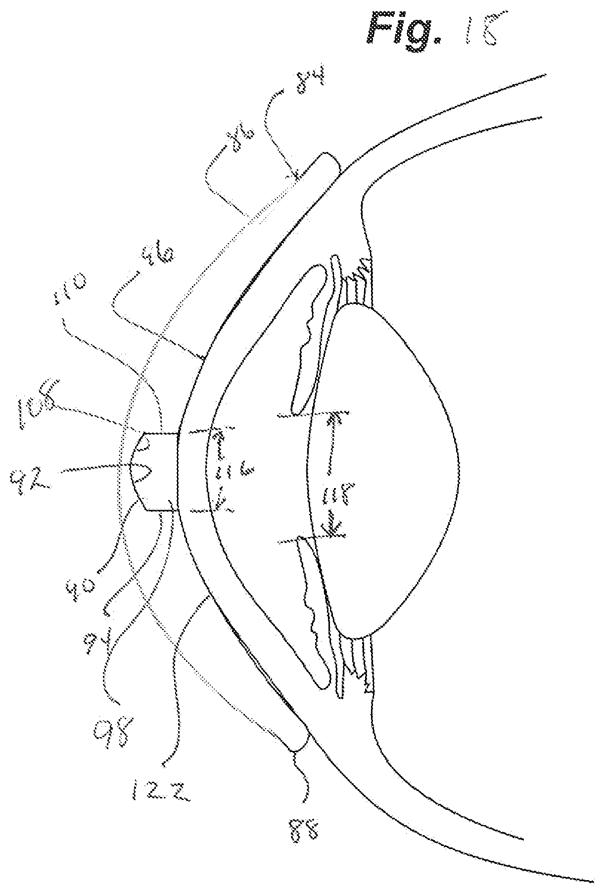 Patent US12105359 Figure 12 – Tear shaping for refractive correction