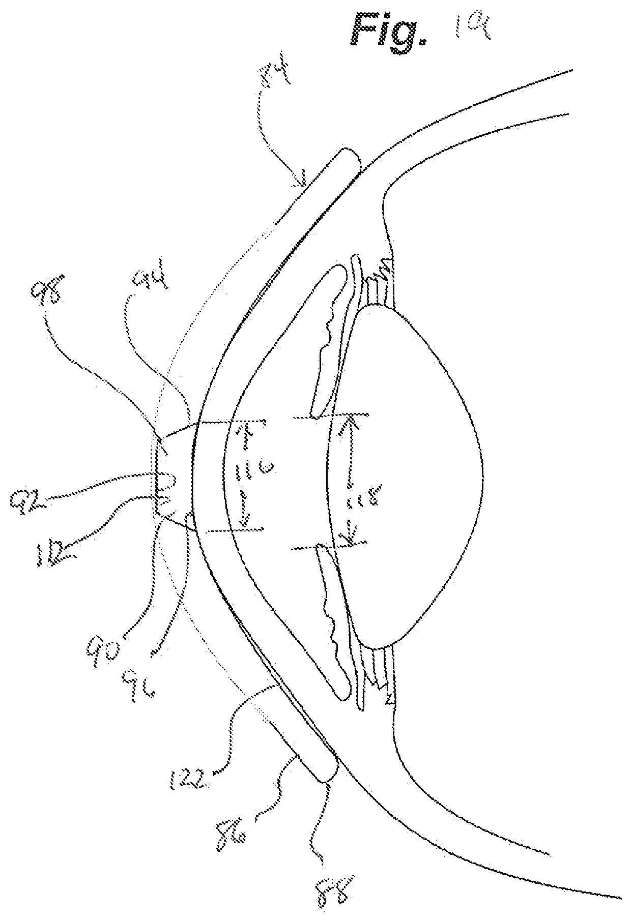 Patent US12105359 Figure 13 – Tear shaping for refractive correction