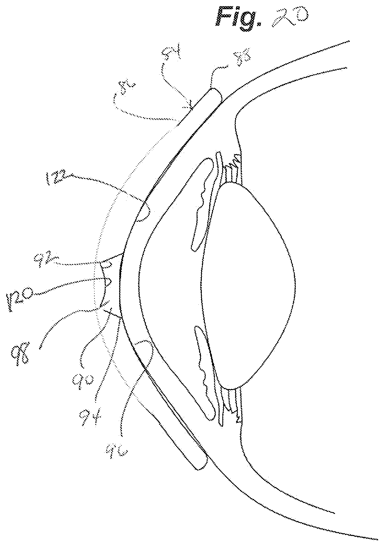 Patent US12105359 Figure 14 – Tear shaping for refractive correction