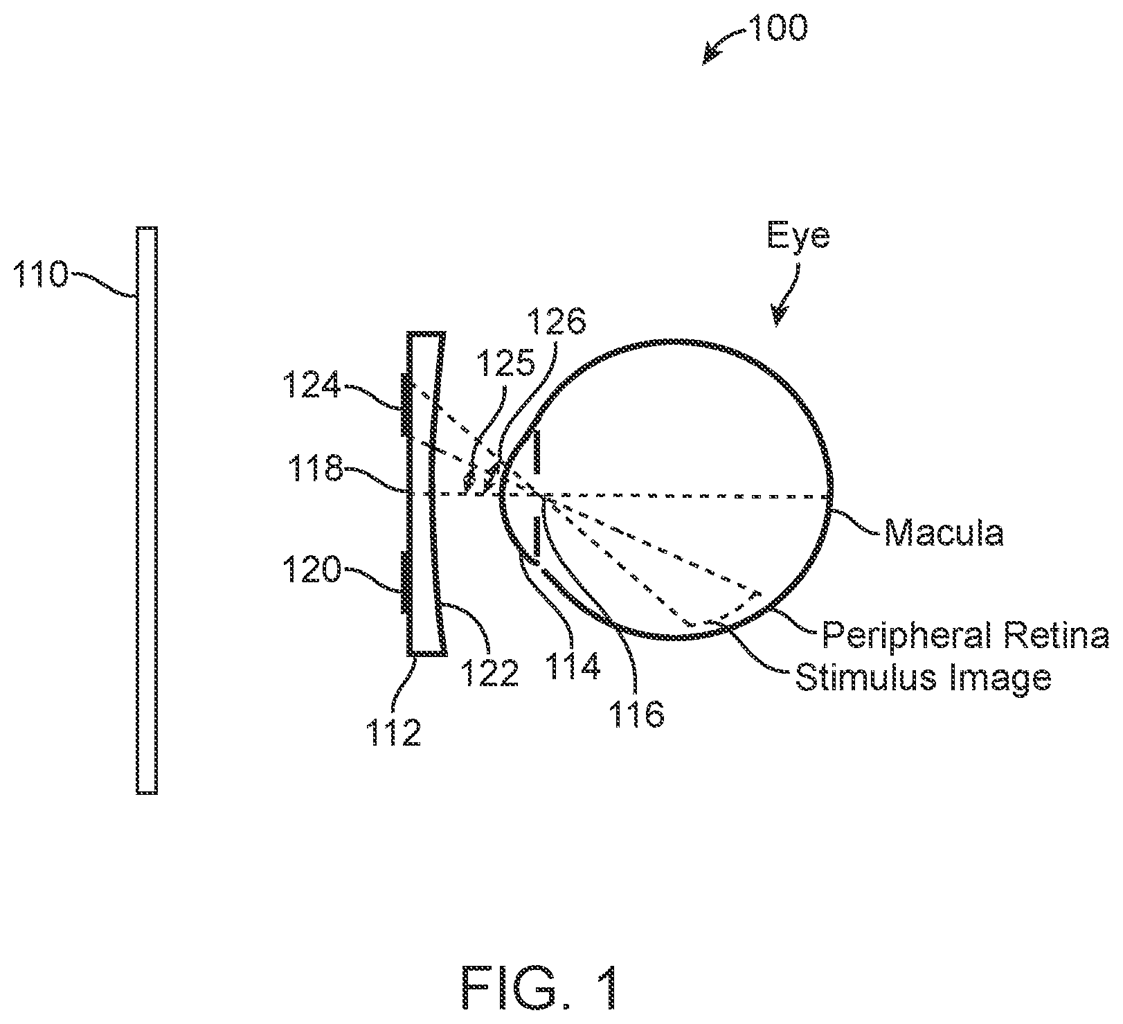 Patent US12105362 Figure 1 – Stick on devices using peripheral defocus to treat progressive refractive error