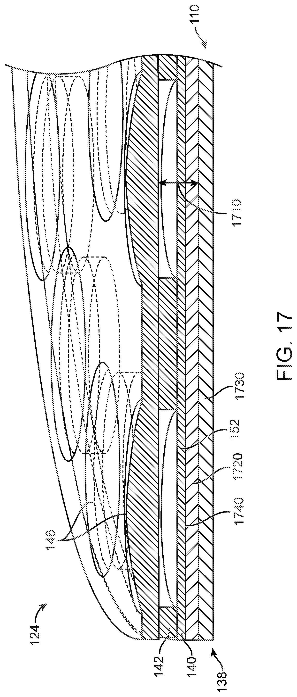 Patent US12105362 Figure 17 – Stick on devices using peripheral defocus to treat progressive refractive error