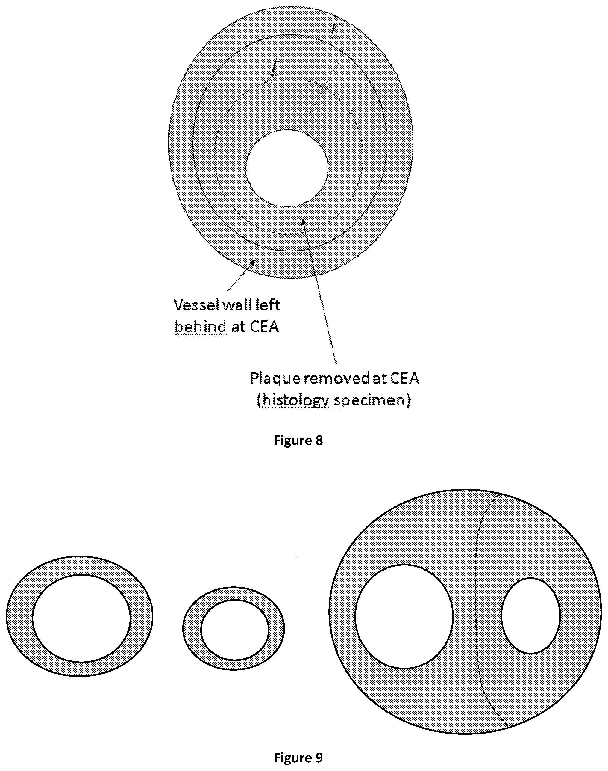 Patent US12106477 Figure 6 – Segmenting permeability, neovascularization, necrosis, collagen breakdown, or inflammation to characterize atherosclerotic plaque, coronary artery disease, or vasculopathy