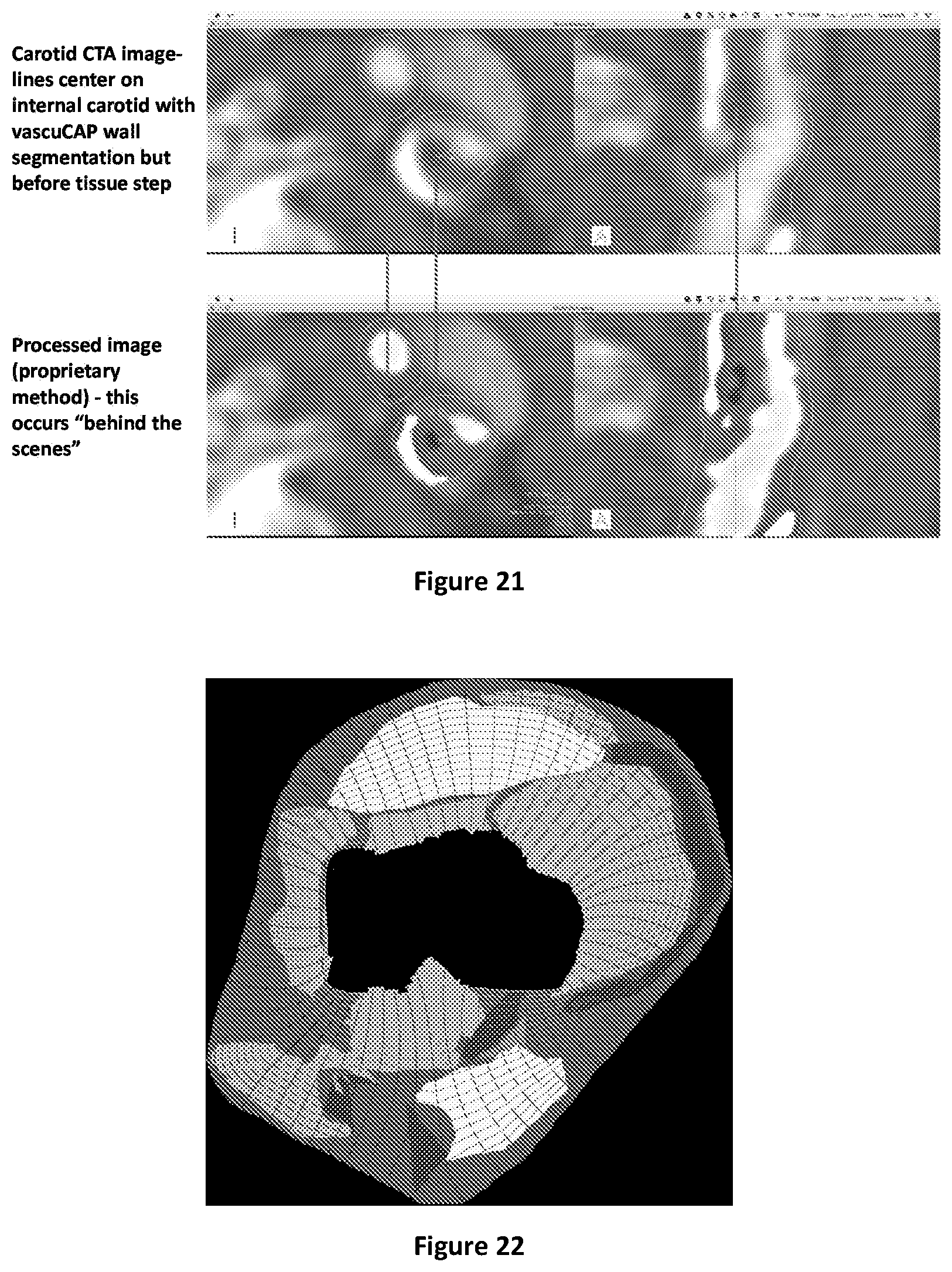 Patent US12106477 Figure 13 – Segmenting permeability, neovascularization, necrosis, collagen breakdown, or inflammation to characterize atherosclerotic plaque, coronary artery disease, or vasculopathy
