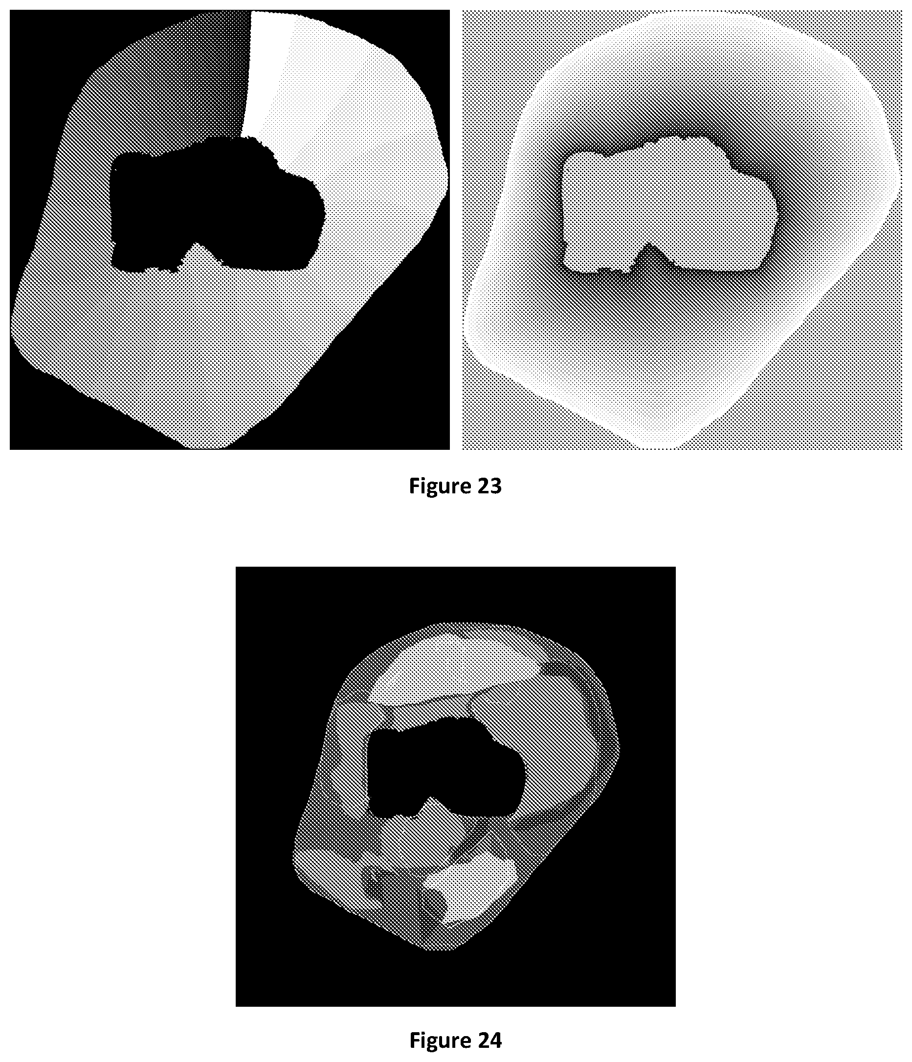Patent US12106477 Figure 14 – Segmenting permeability, neovascularization, necrosis, collagen breakdown, or inflammation to characterize atherosclerotic plaque, coronary artery disease, or vasculopathy