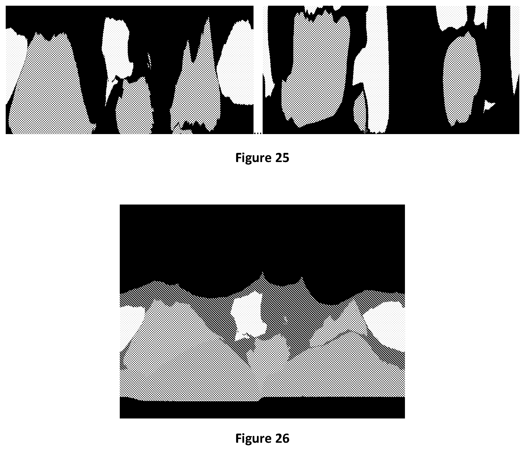 Patent US12106477 Figure 15 – Segmenting permeability, neovascularization, necrosis, collagen breakdown, or inflammation to characterize atherosclerotic plaque, coronary artery disease, or vasculopathy