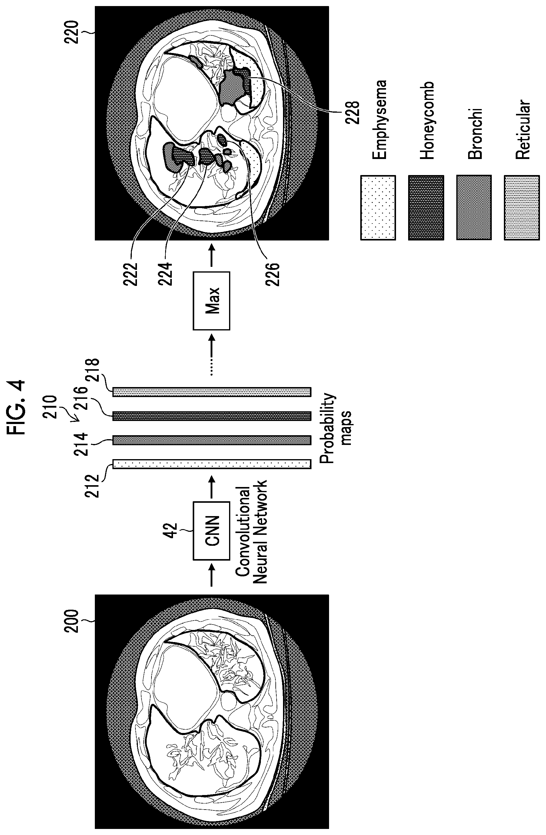Patent US12106856 Figure 4 – Image processing apparatus, image processing method, and program for segmentation correction of medical image