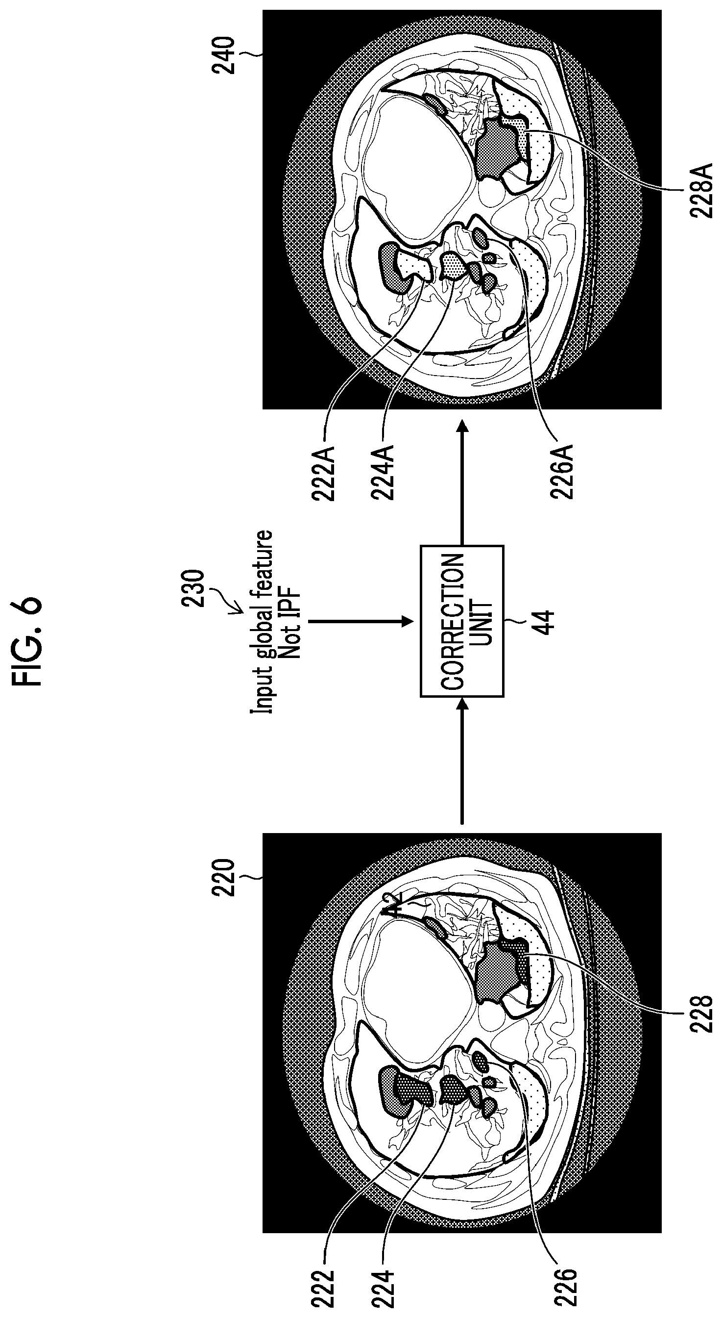 Patent US12106856 Figure 6 – Image processing apparatus, image processing method, and program for segmentation correction of medical image
