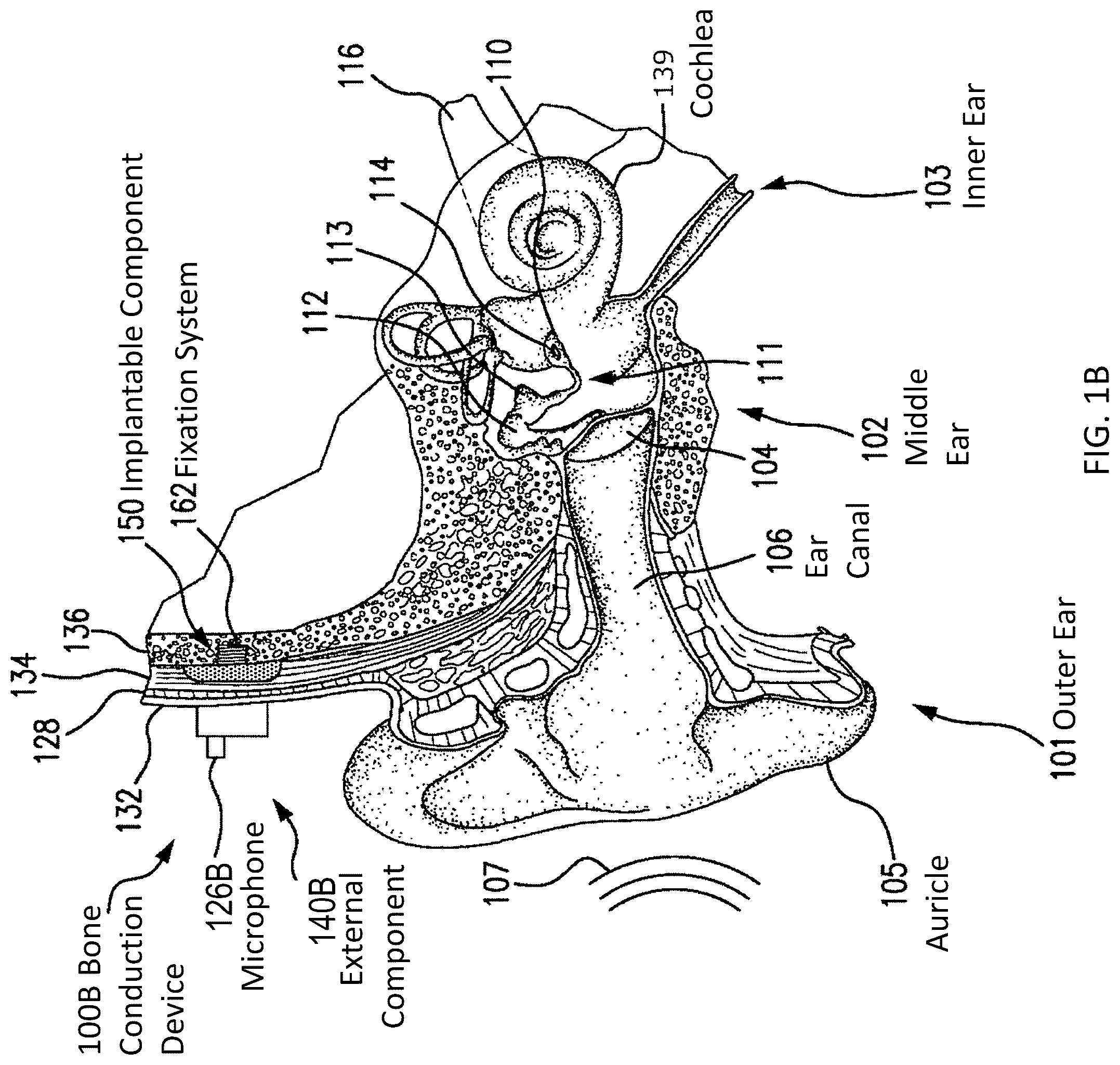 Patent US12108216 Figure 2 – Impact and resonance management