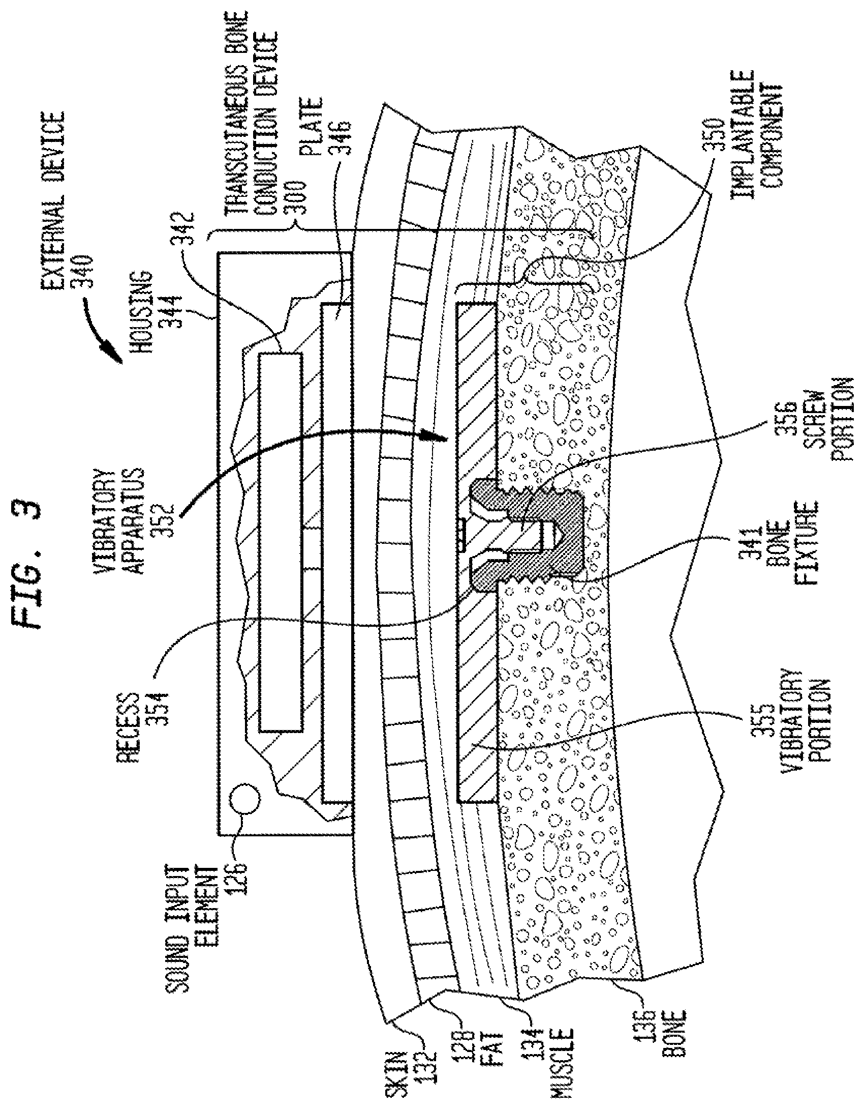 Patent US12108216 Figure 4 – Impact and resonance management