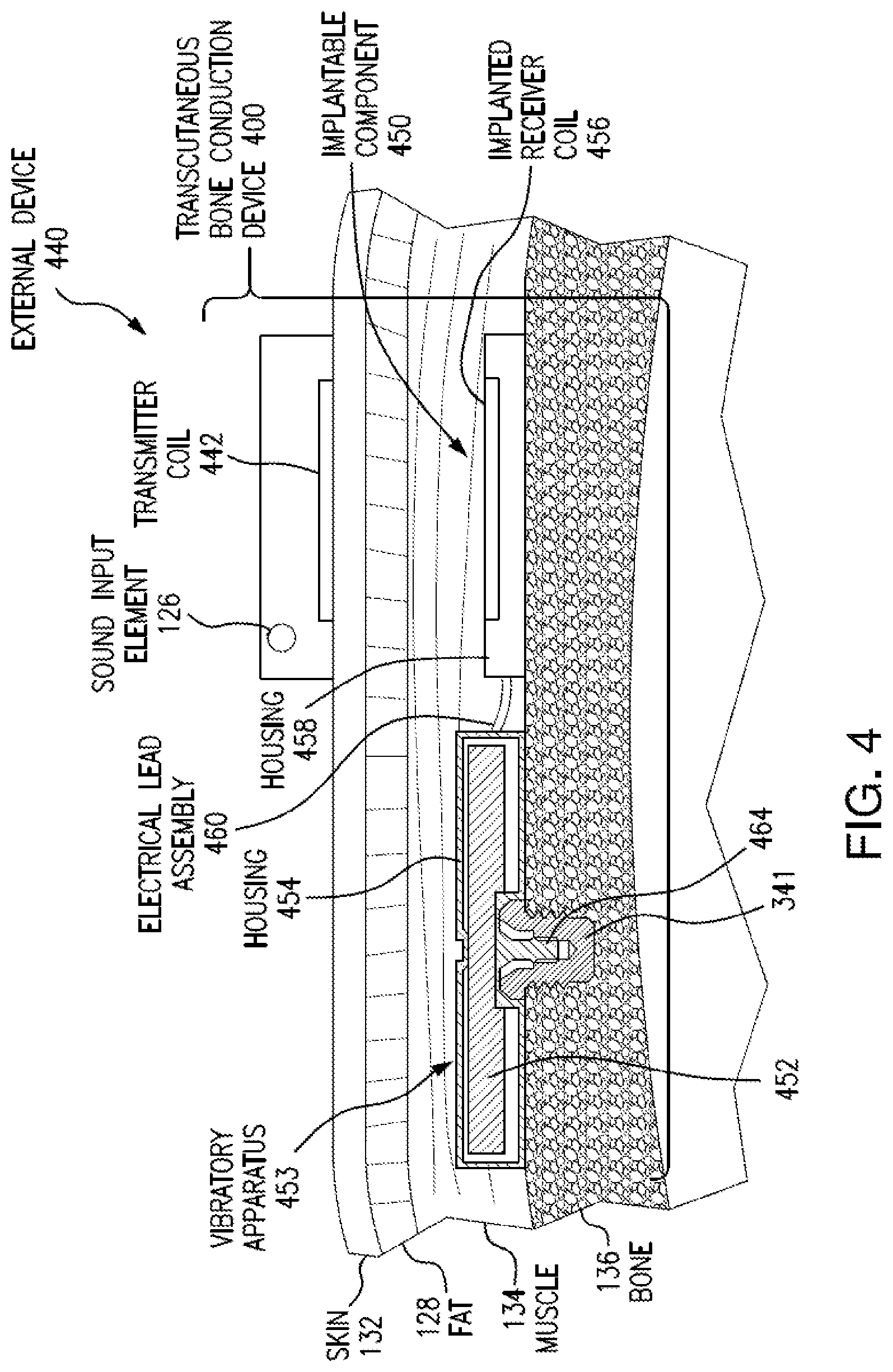 Patent US12108216 Figure 5 – Impact and resonance management