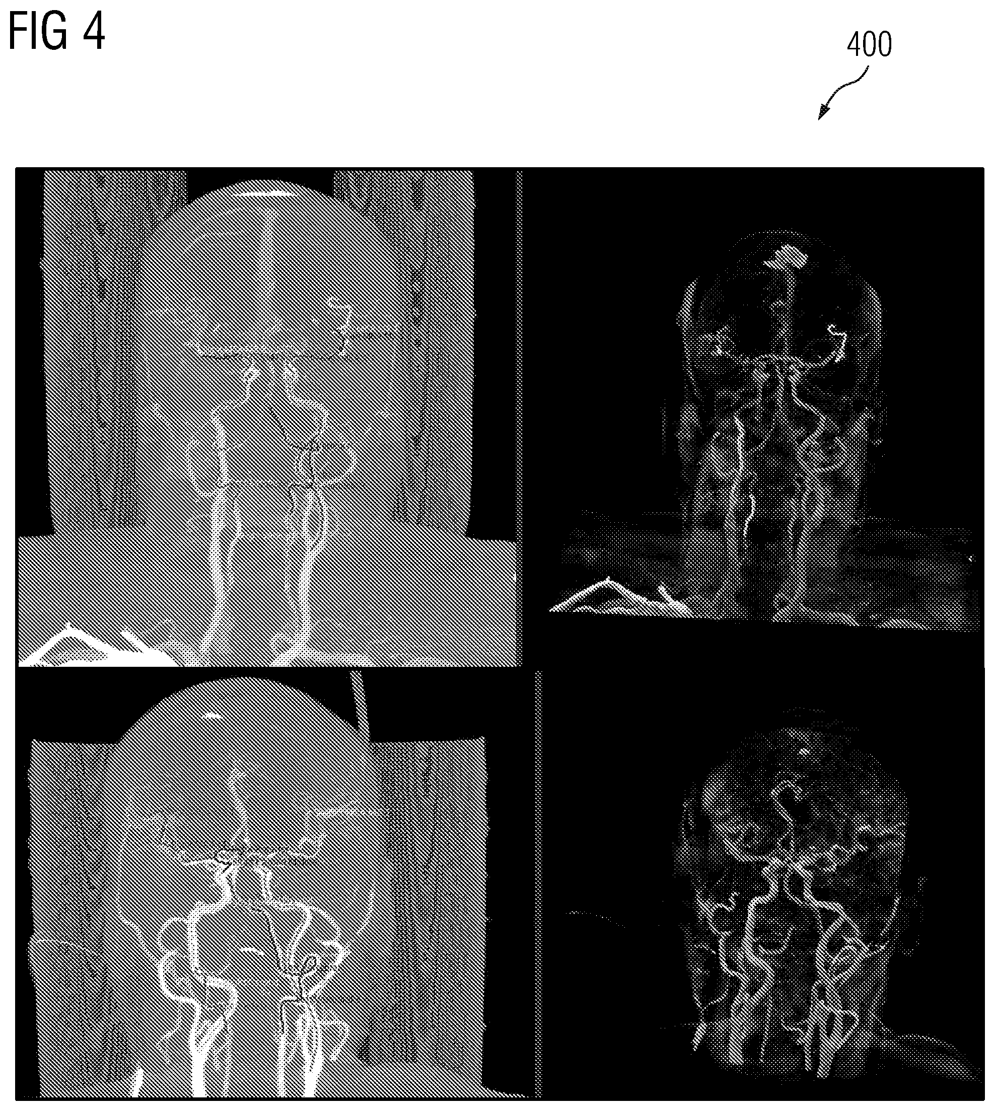 Patent US12112470 Figure 4 – Probabilistic tree tracing and large vessel occlusion detection in medical imaging