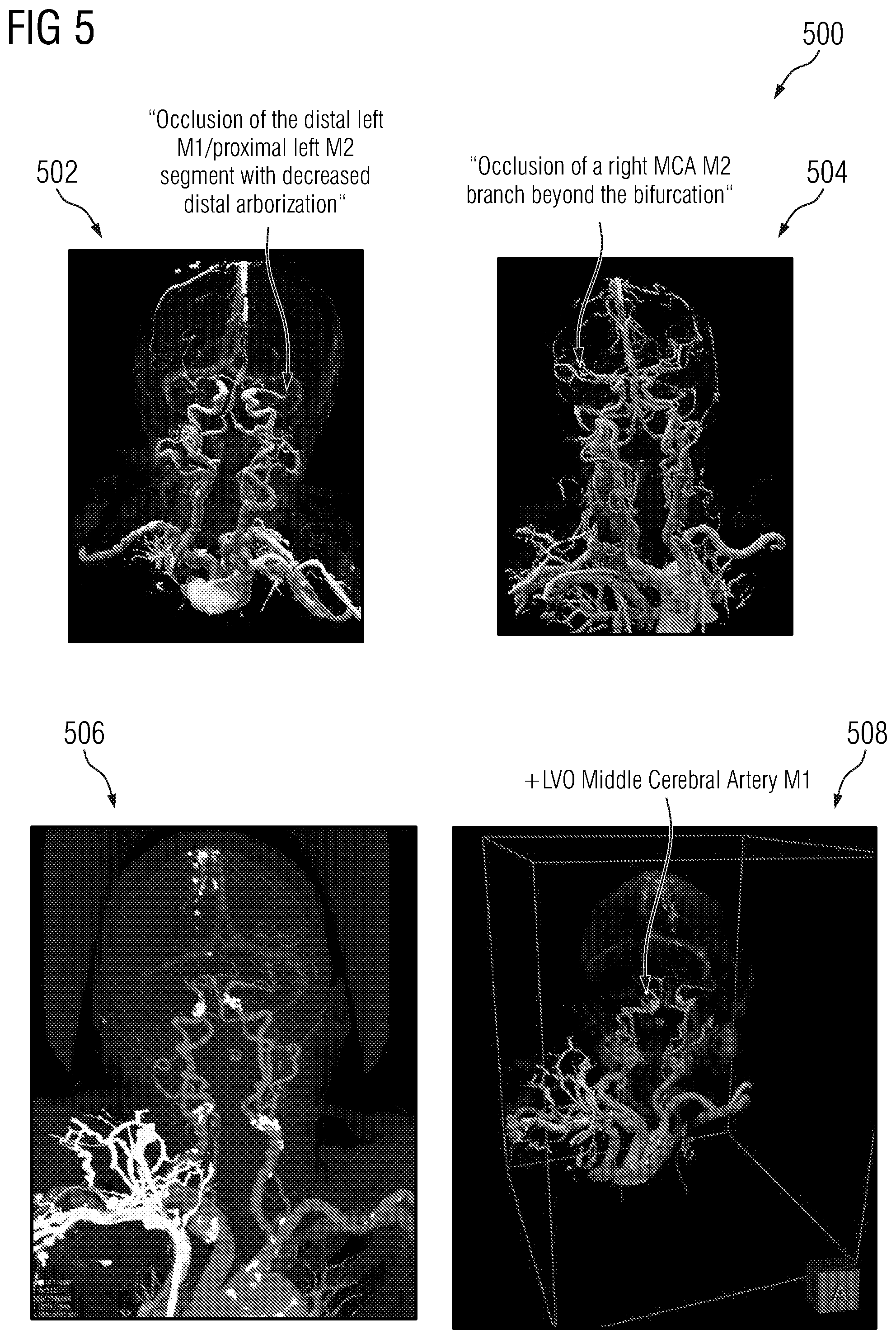 Patent US12112470 Figure 5 – Probabilistic tree tracing and large vessel occlusion detection in medical imaging