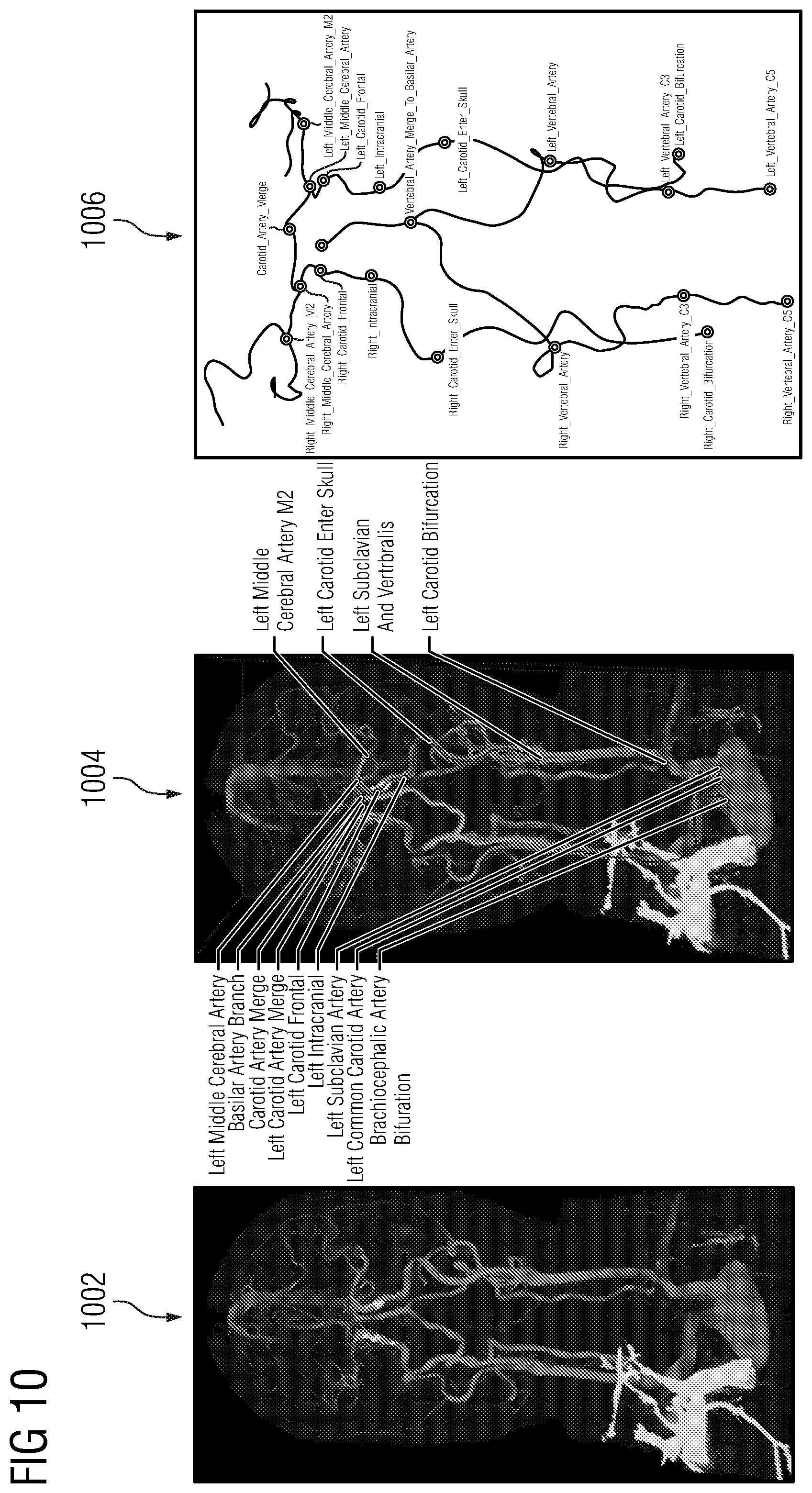 Patent US12112470 Figure 10 – Probabilistic tree tracing and large vessel occlusion detection in medical imaging