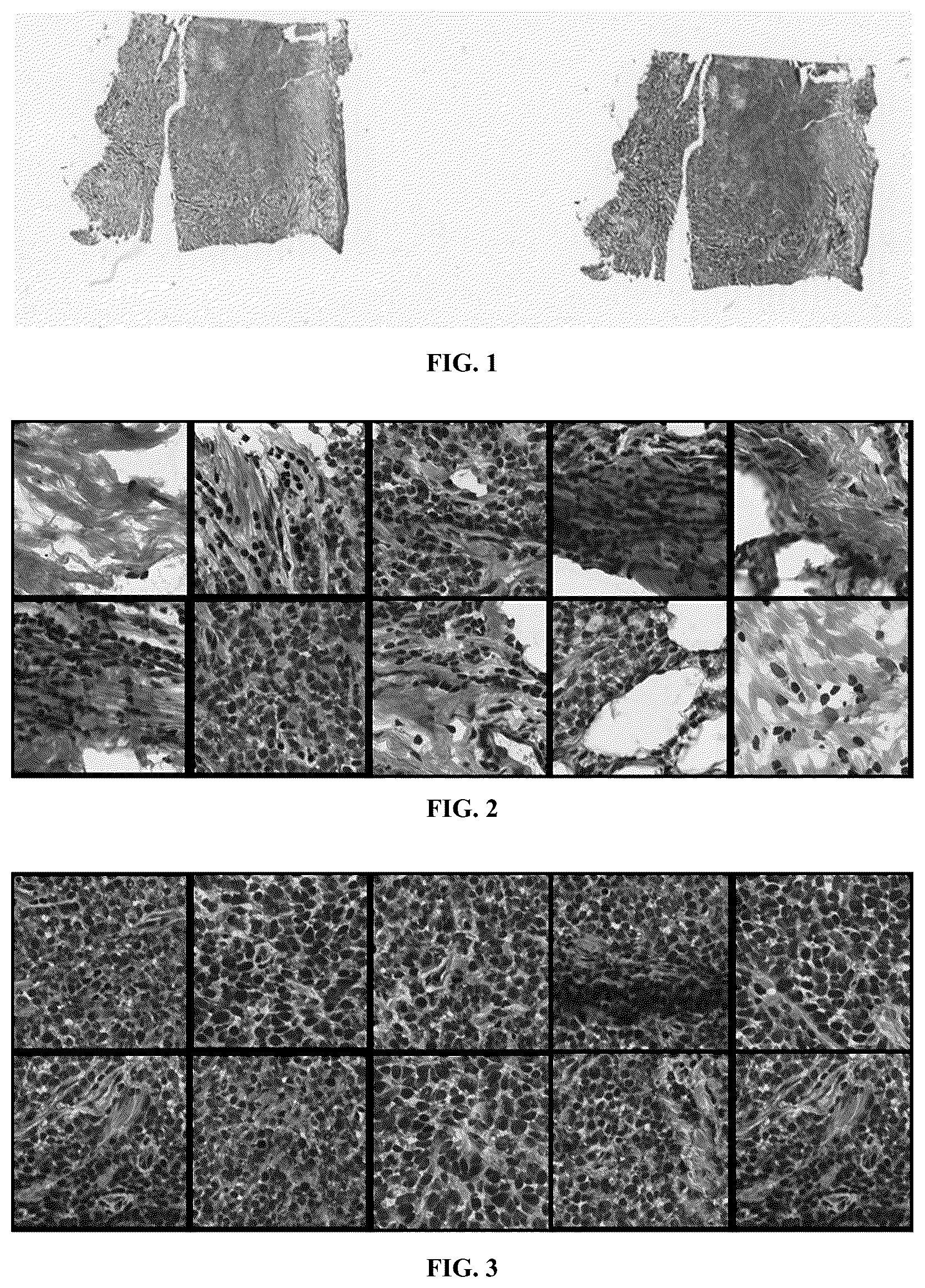 Patent US12112475 — Method and system for predicting tumor mutation burden (TMB) in triple negative breast cancer (TNBC) based on nuclear scores and histopathological whole slide images (WSIs) — Figure 1