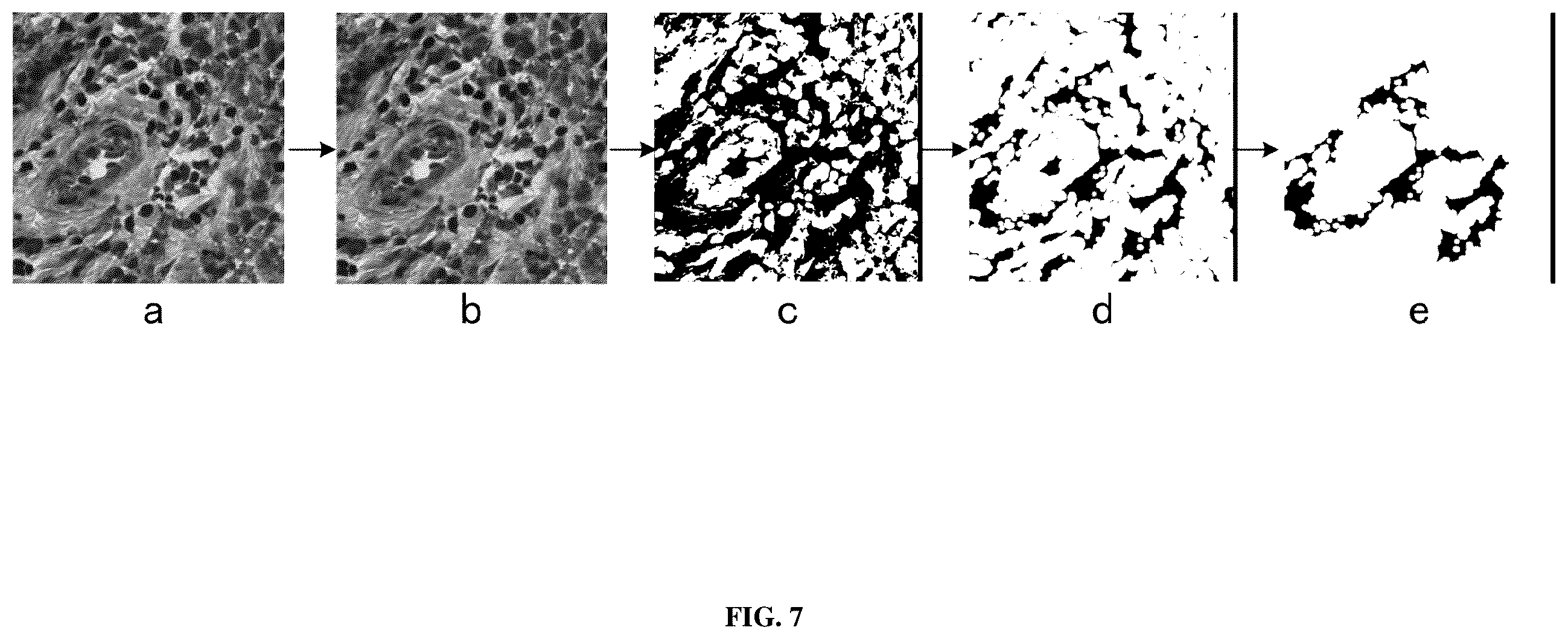 Patent US12112475 Figure 5 – Method and system for predicting tumor mutation burden (TMB) in triple negative breast cancer (TNBC) based on nuclear scores and histopathological whole slide images (WSIs)