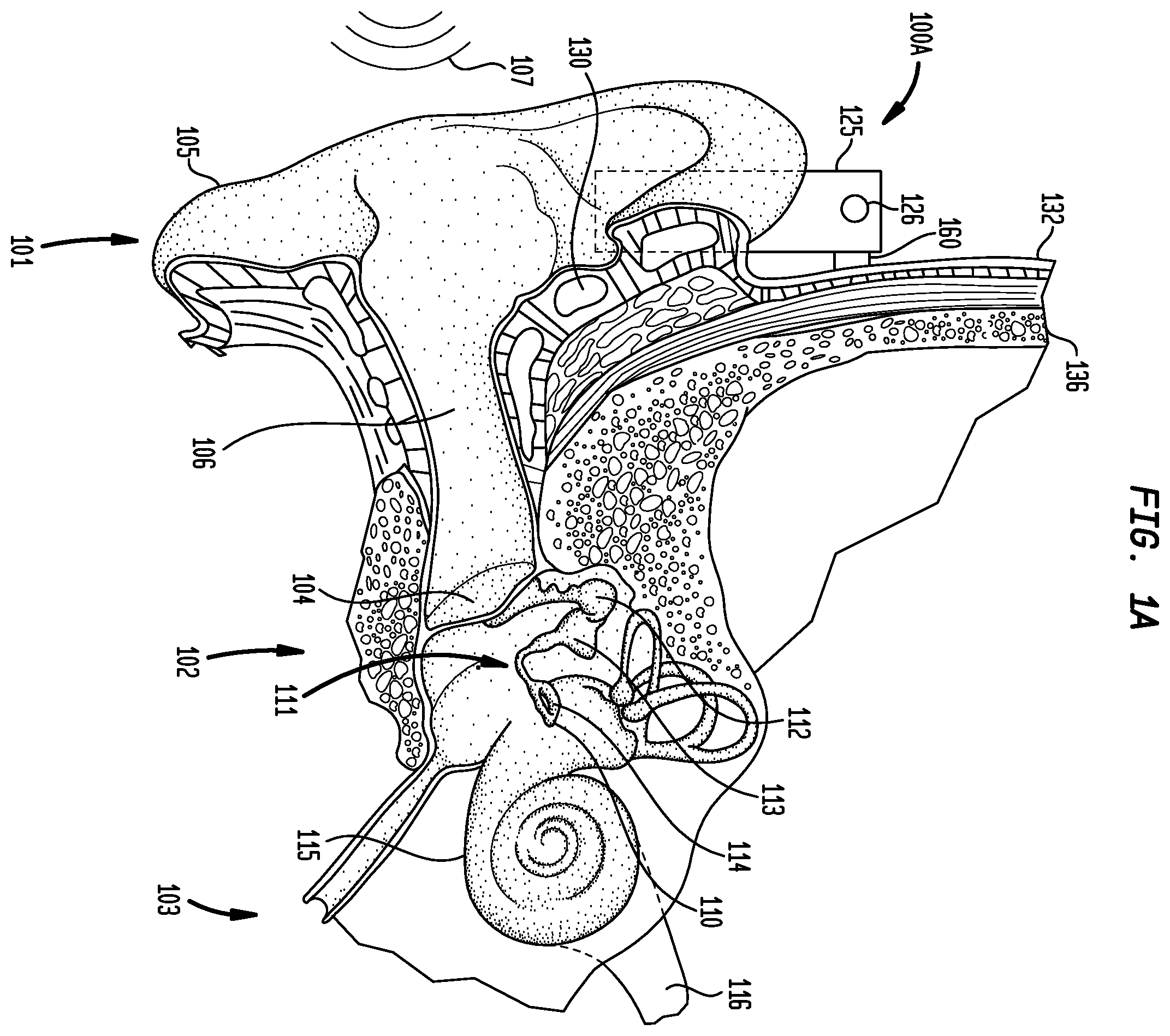 Patent US12126966 Figure 1 – Medical device having an impulse force-resistant component
