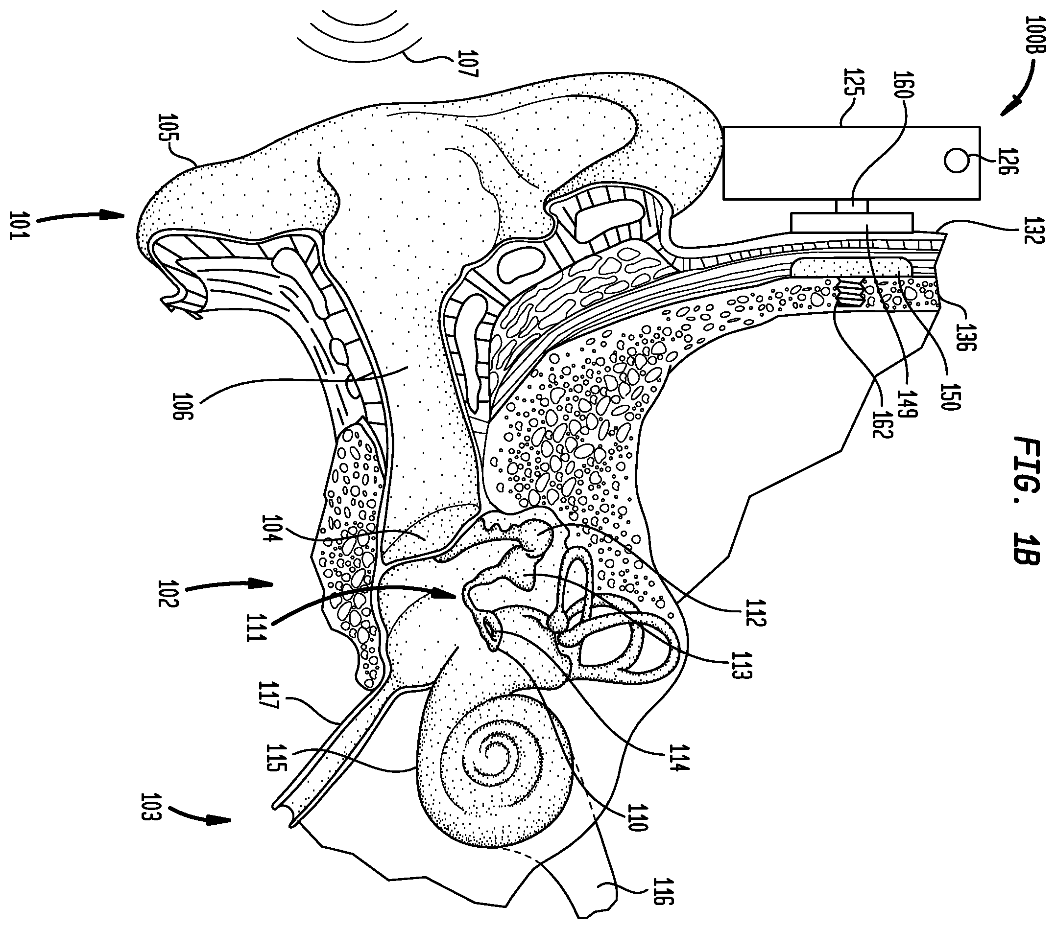 Patent US12126966 Figure 2 – Medical device having an impulse force-resistant component