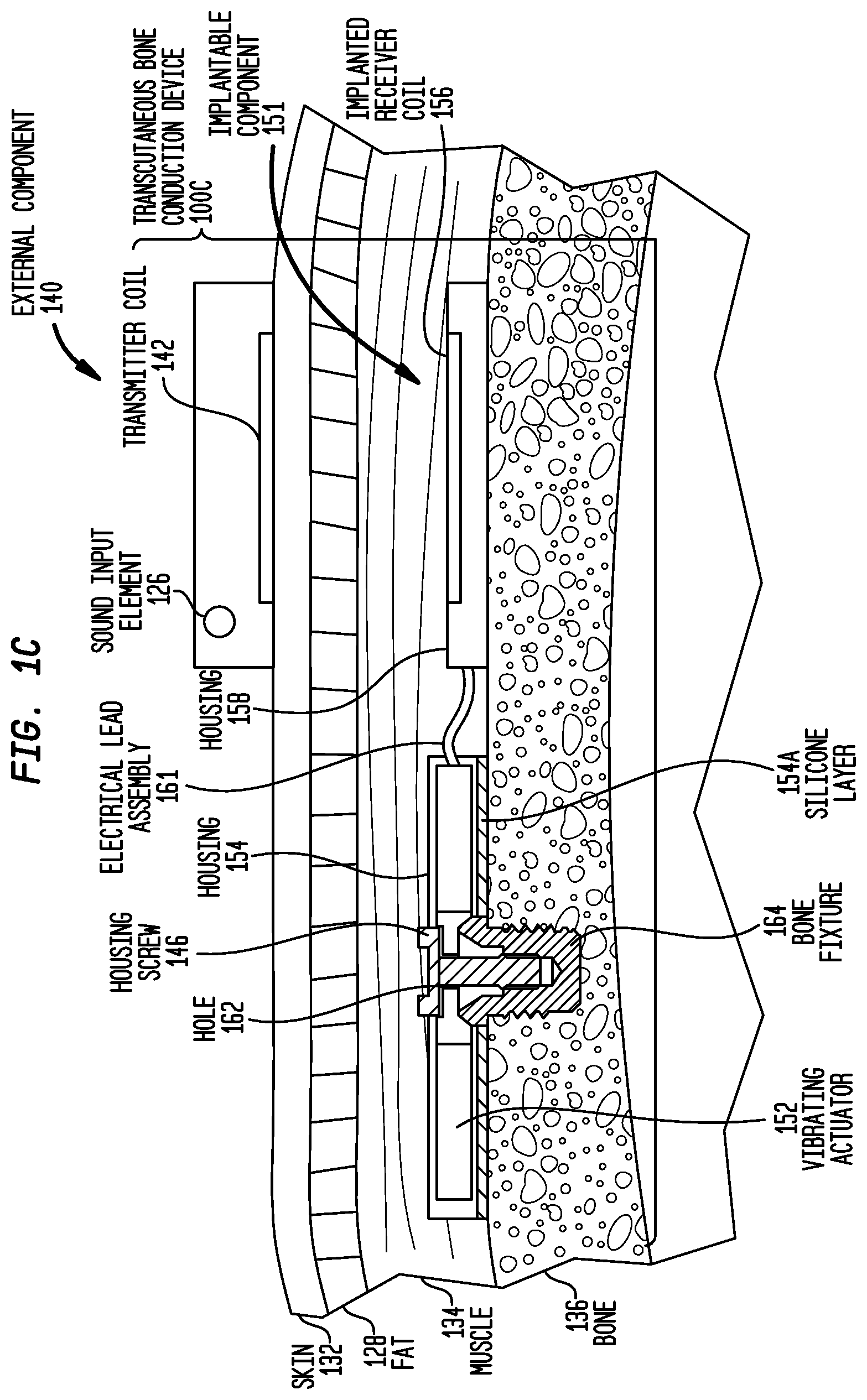 Patent US12126966 Figure 3 – Medical device having an impulse force-resistant component