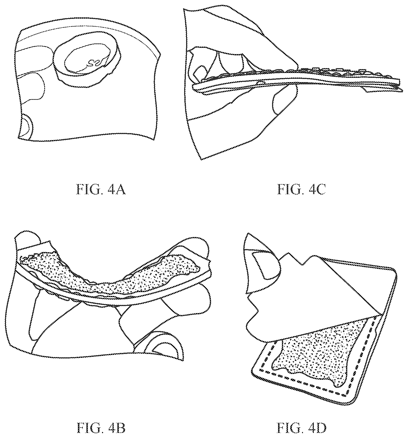 Patent US12128290 Figure 4 – Digital patch for discrete signaling, a baseball glove including same, and related method of manufacture