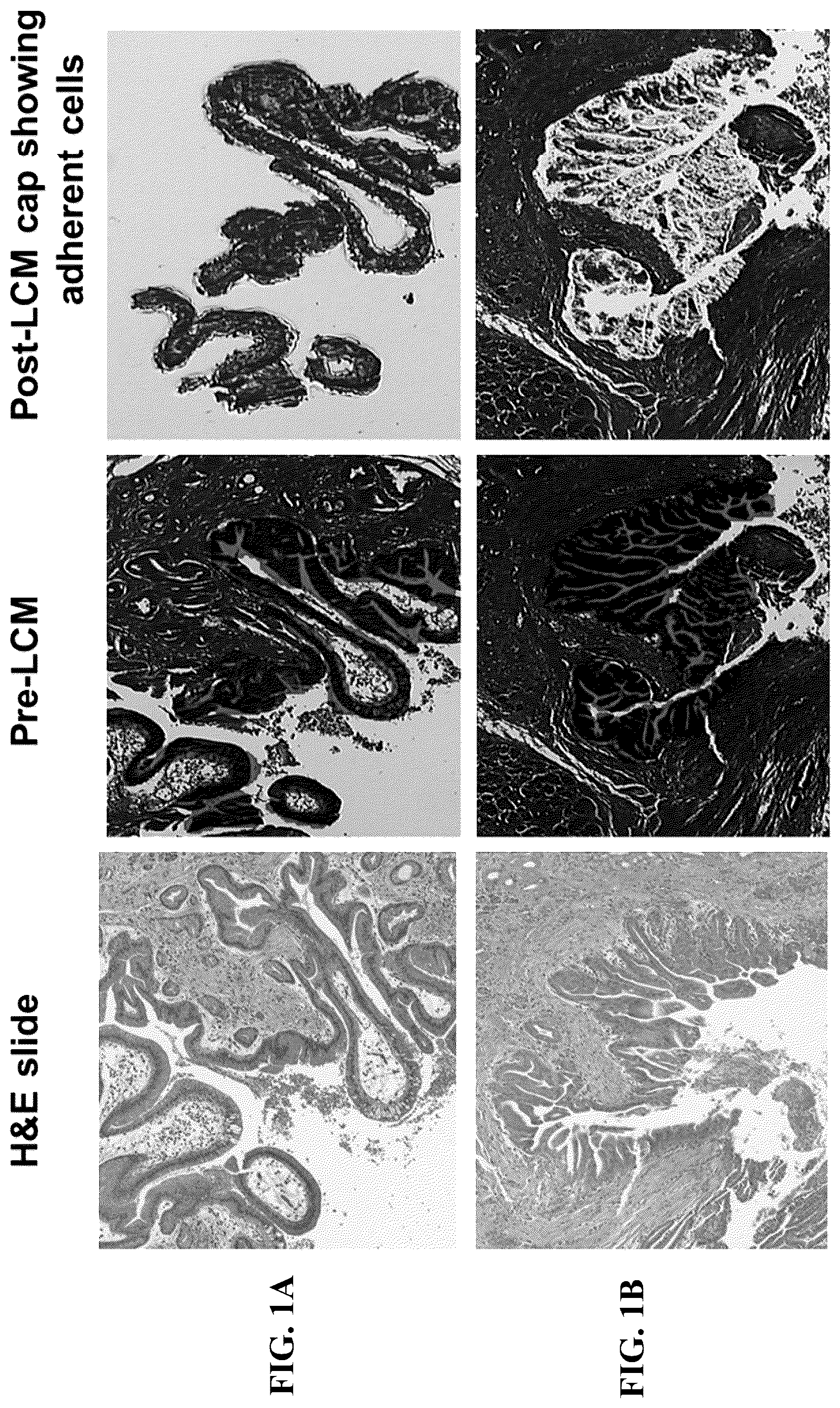 Patent US12129522 Figure 1 – MicroRNA assay for detection and management of pancreatic cancer precursors