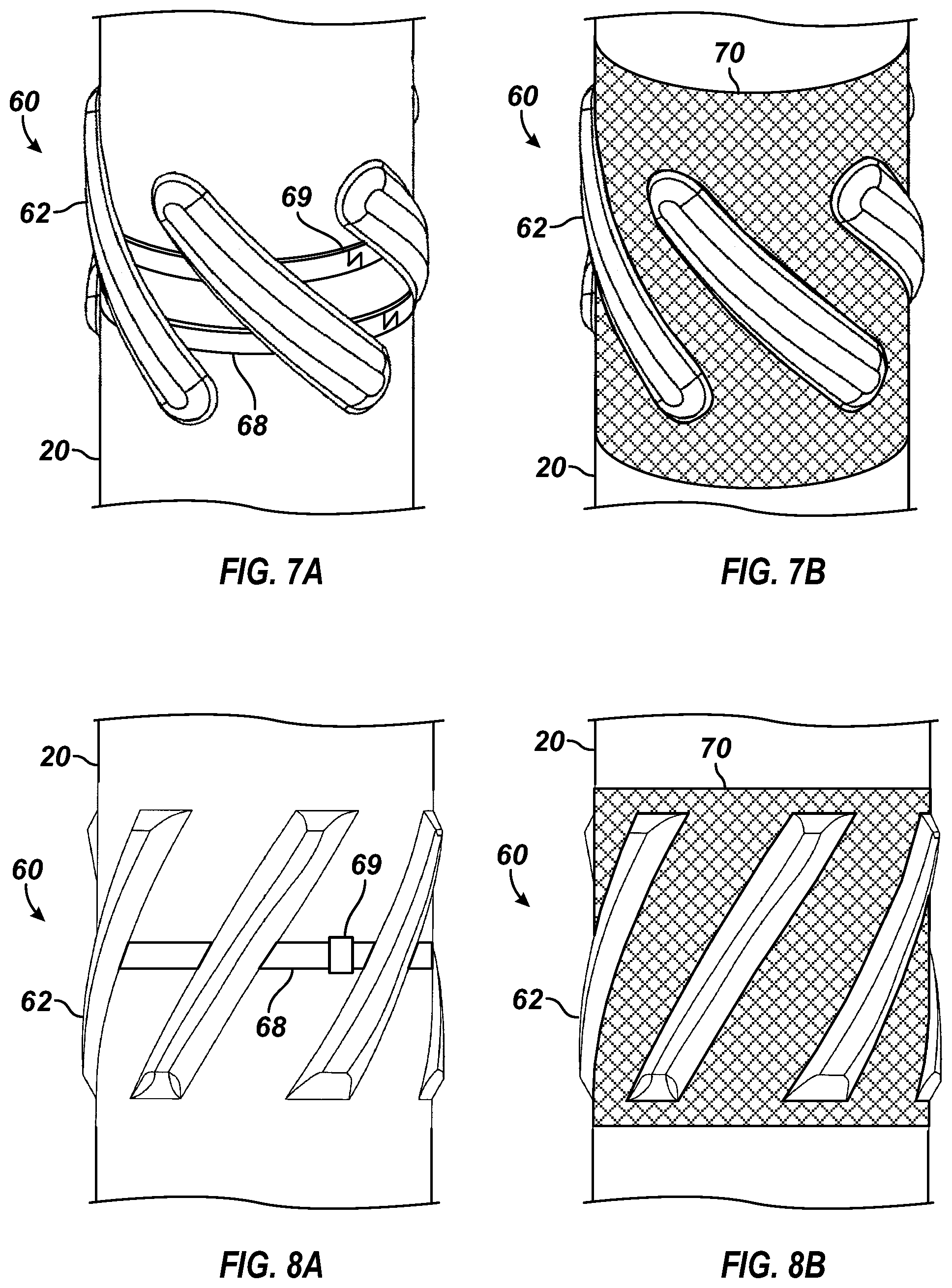 Patent US12129718 Figure 4 – Apparatus and method to form centralizer blades on wellbore tubular