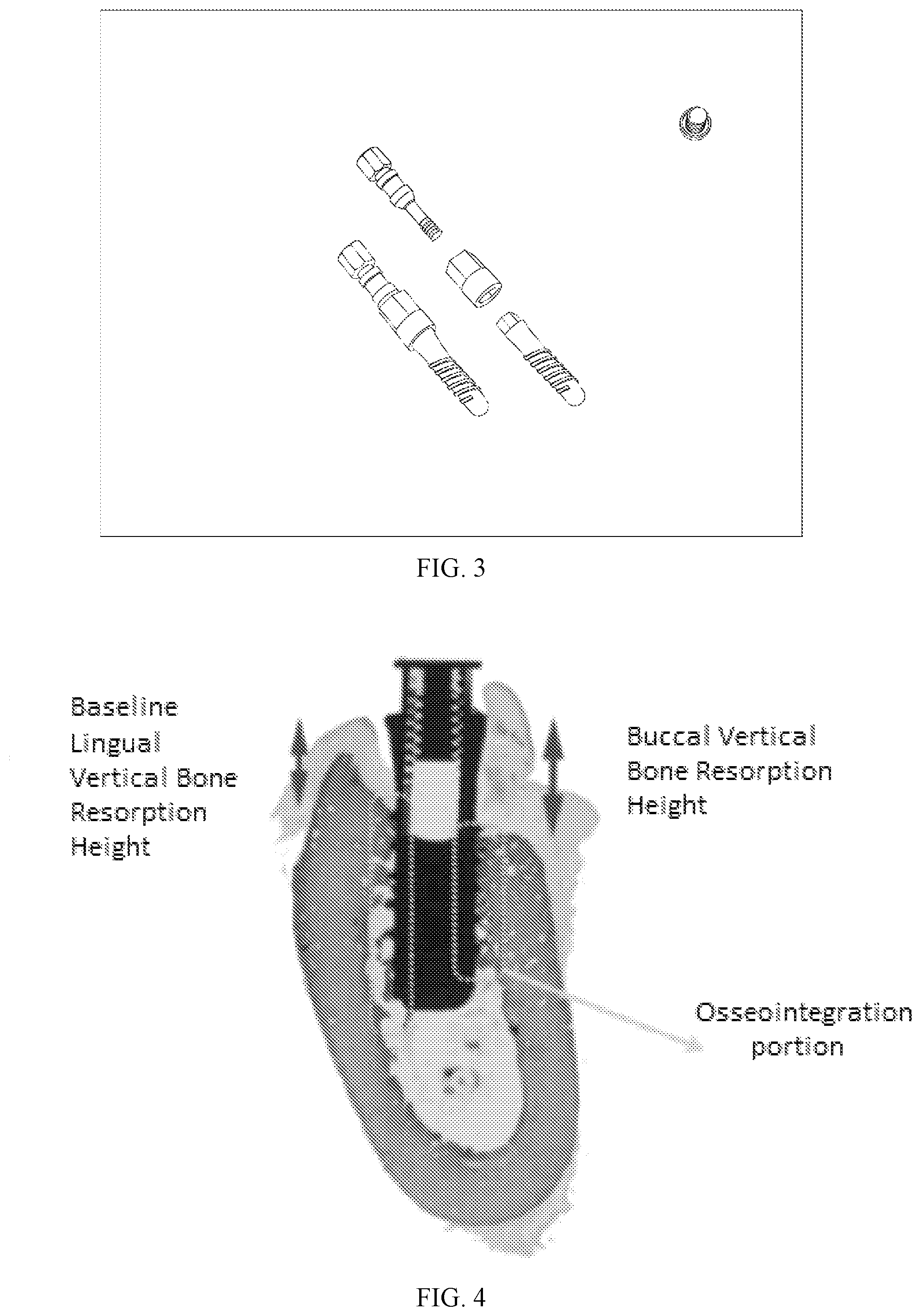 Patent US12134815 Figure 3 – Implant-specific medical titanium alloy achieving immediate implant placement and preparation method for implant-specific medical titanium alloy