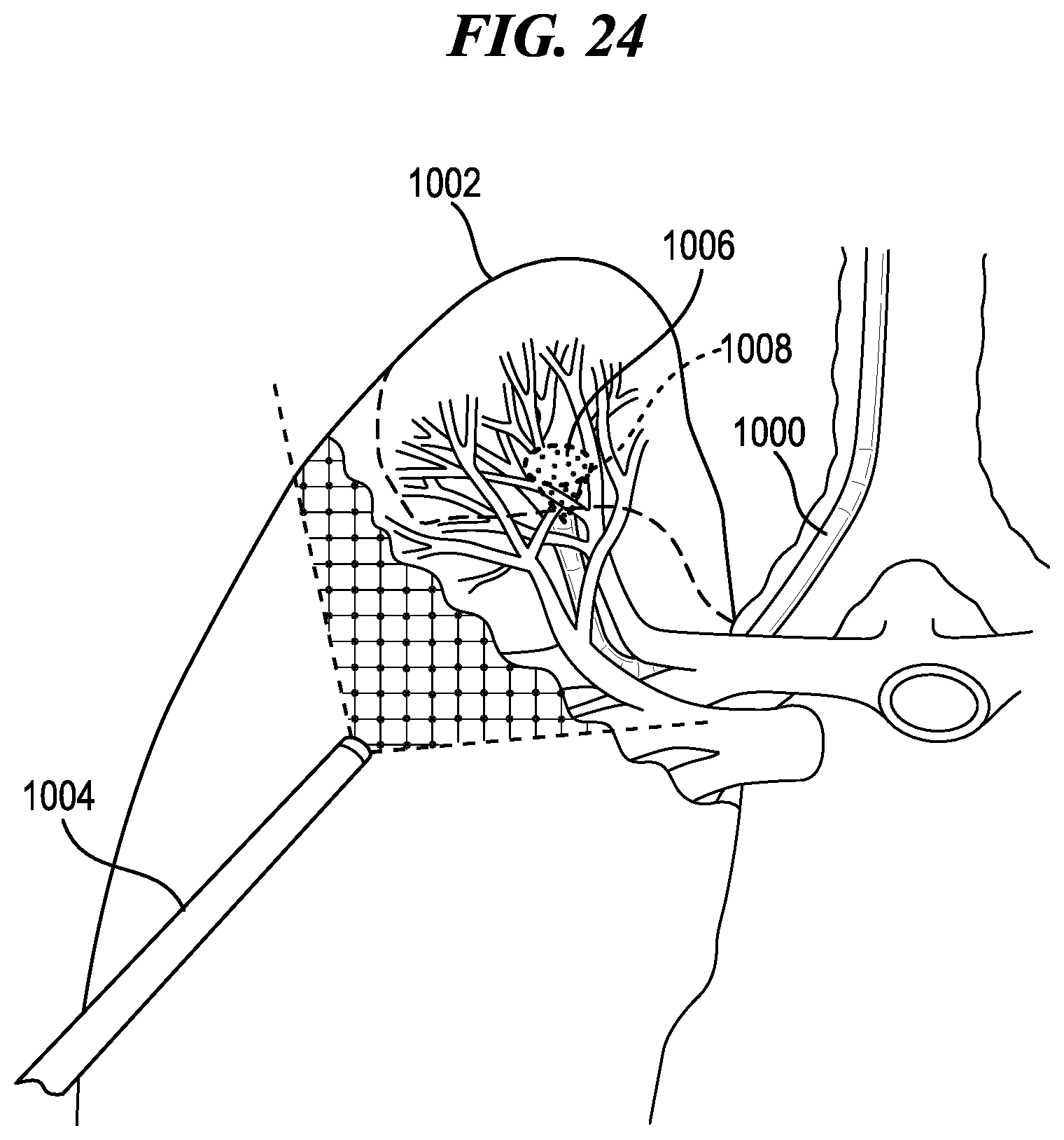 Patent US12137872 Figure 17 – Surgical devices, systems, and methods using multi-source imaging