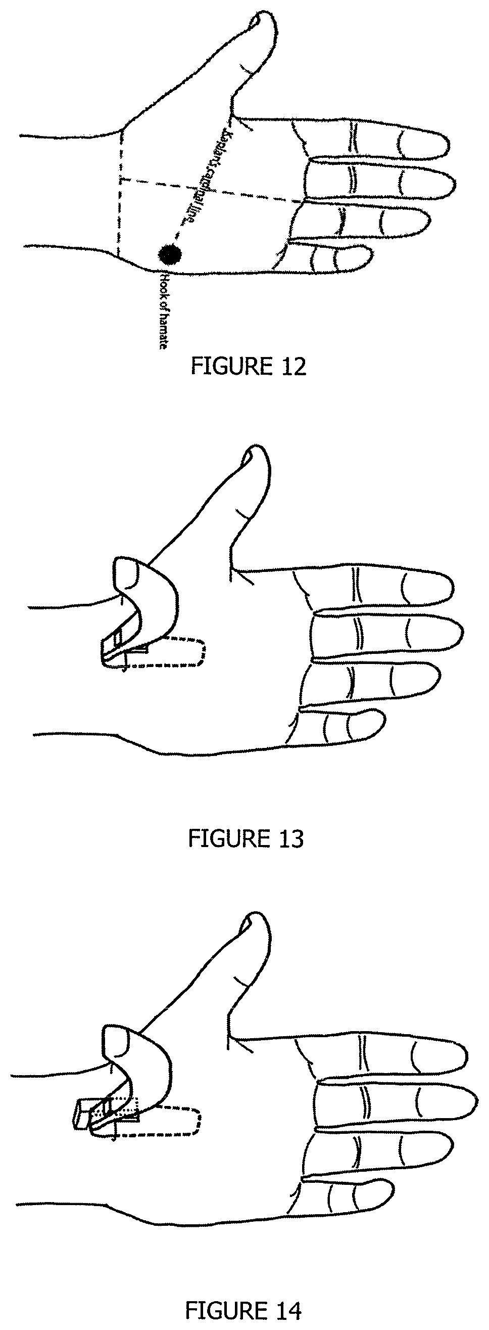 Patent US12137877 Figure 7 – Endoscopic-release surgical retractor