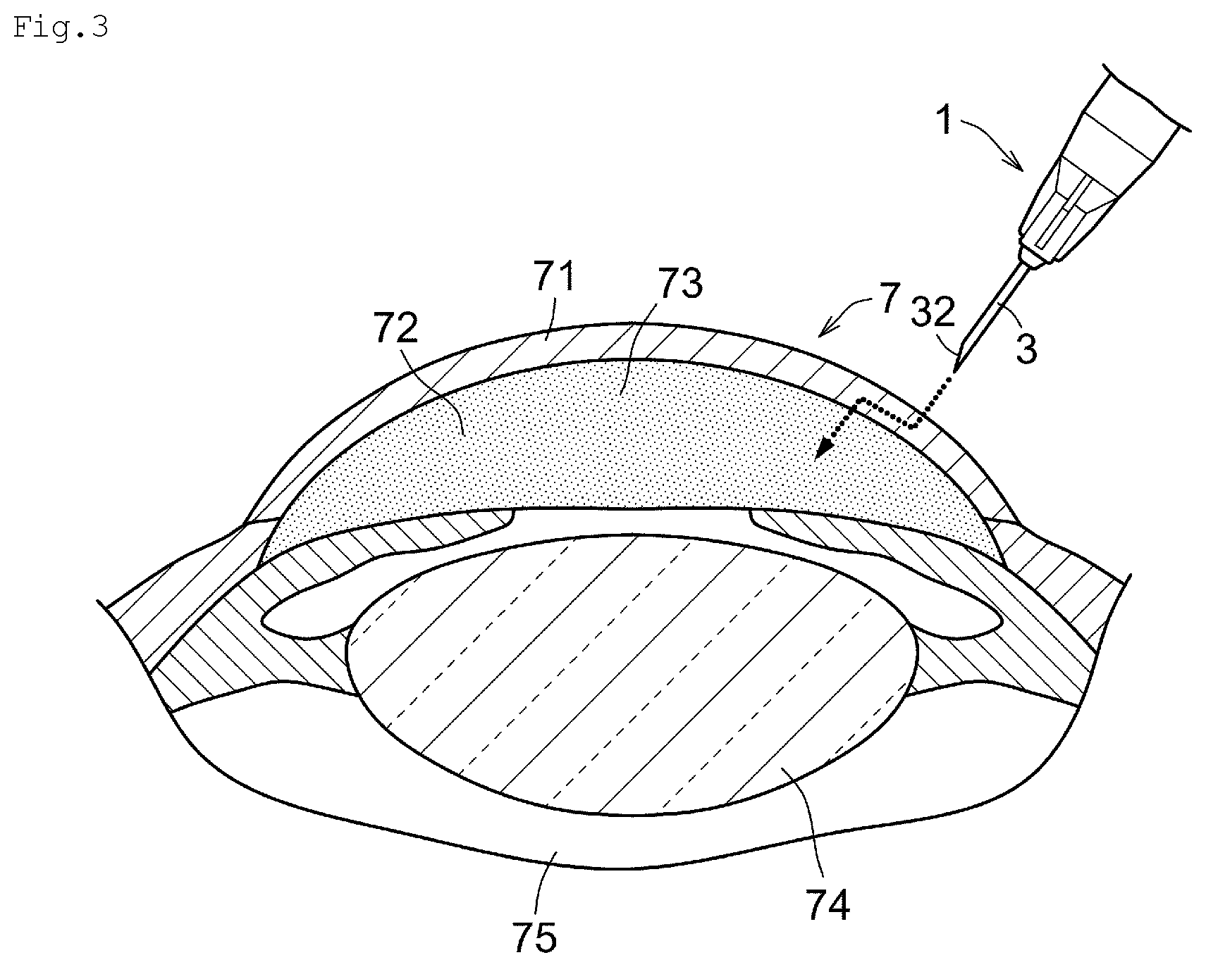Patent US12137885 Figure 3 – Bodily fluid collection device