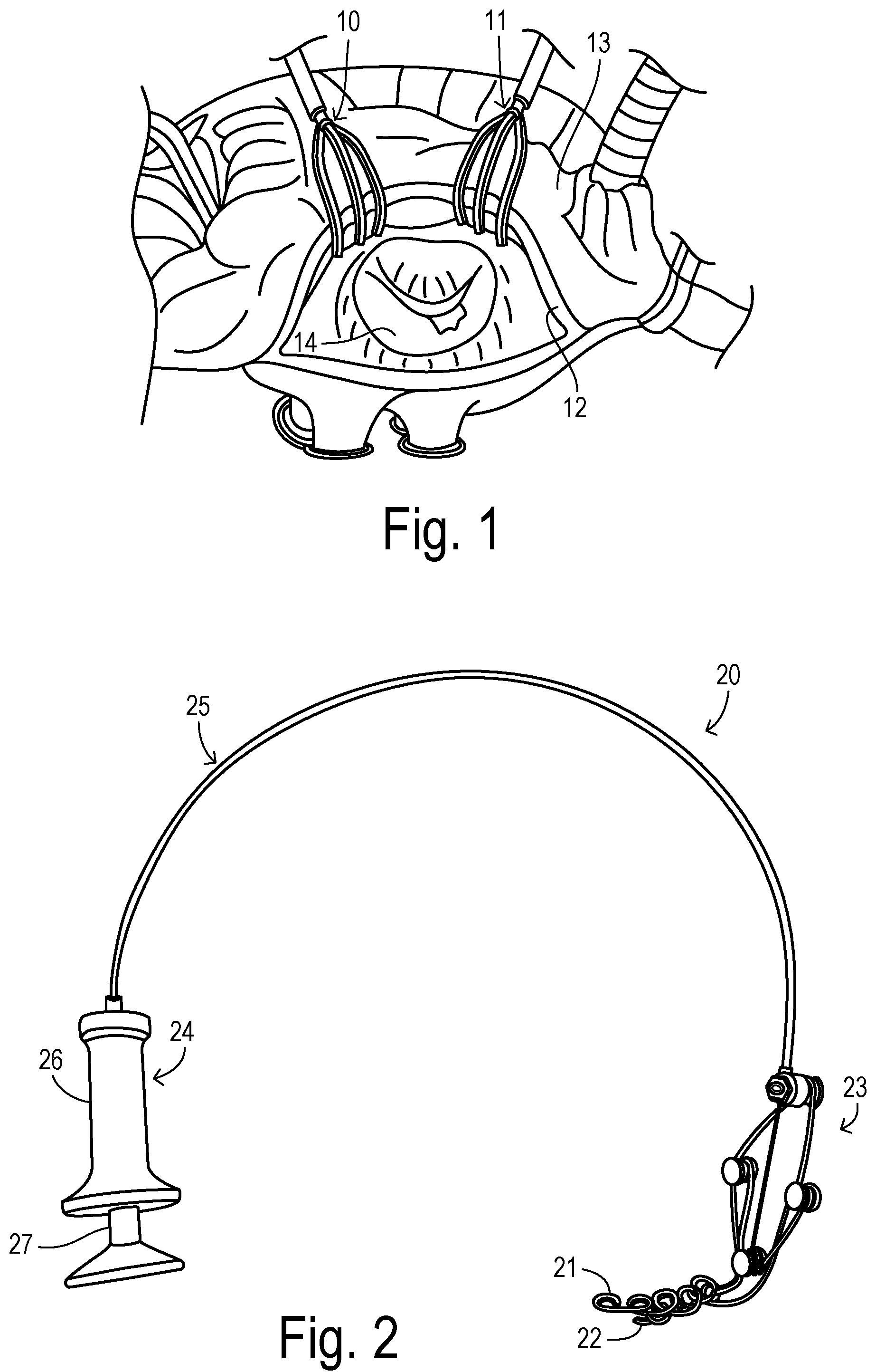 Patent US12137889 Figure 1 – Expansion device for opening valve perimeter in cardiac surgery