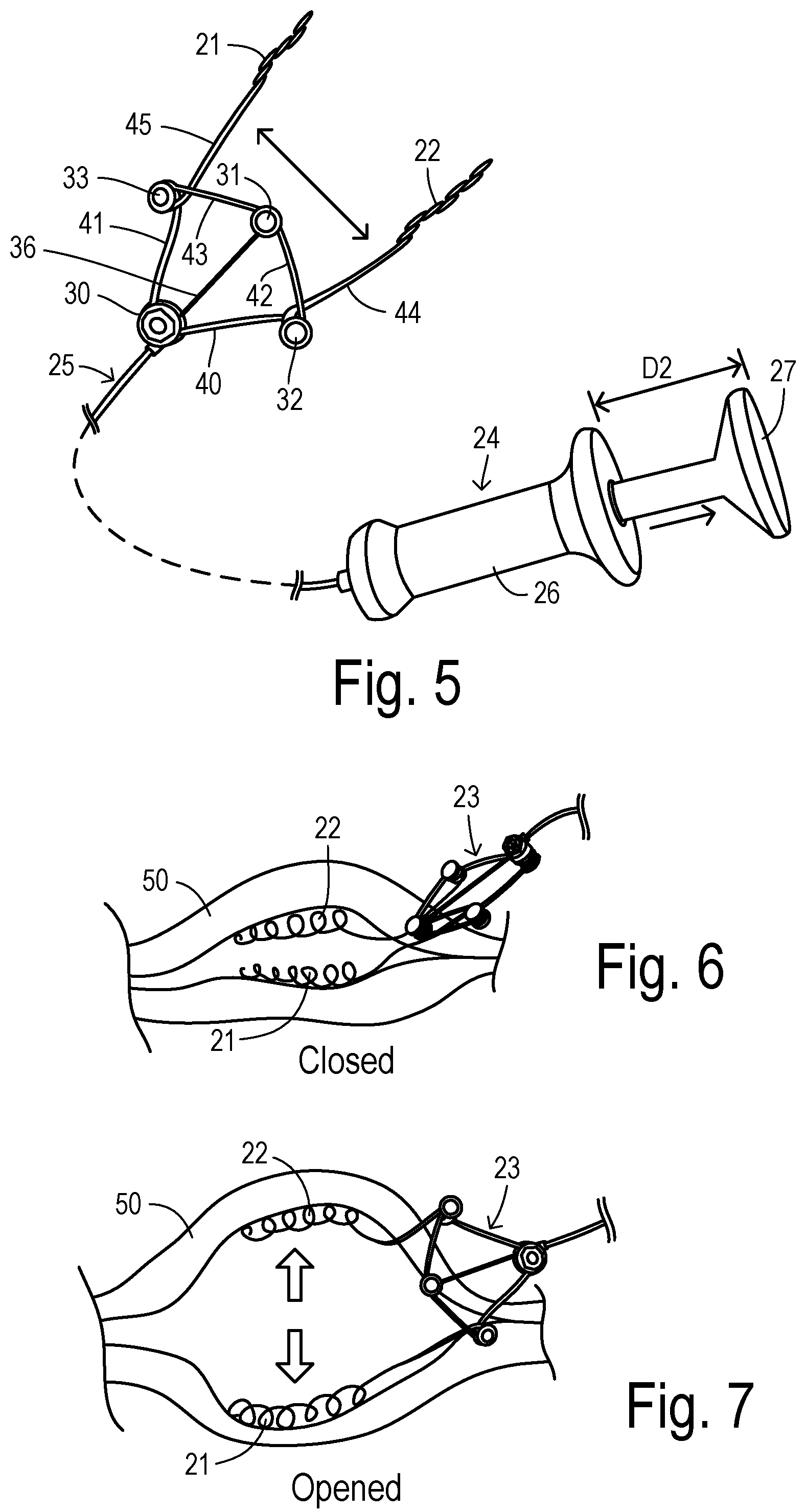 Patent US12137889 Figure 3 – Expansion device for opening valve perimeter in cardiac surgery