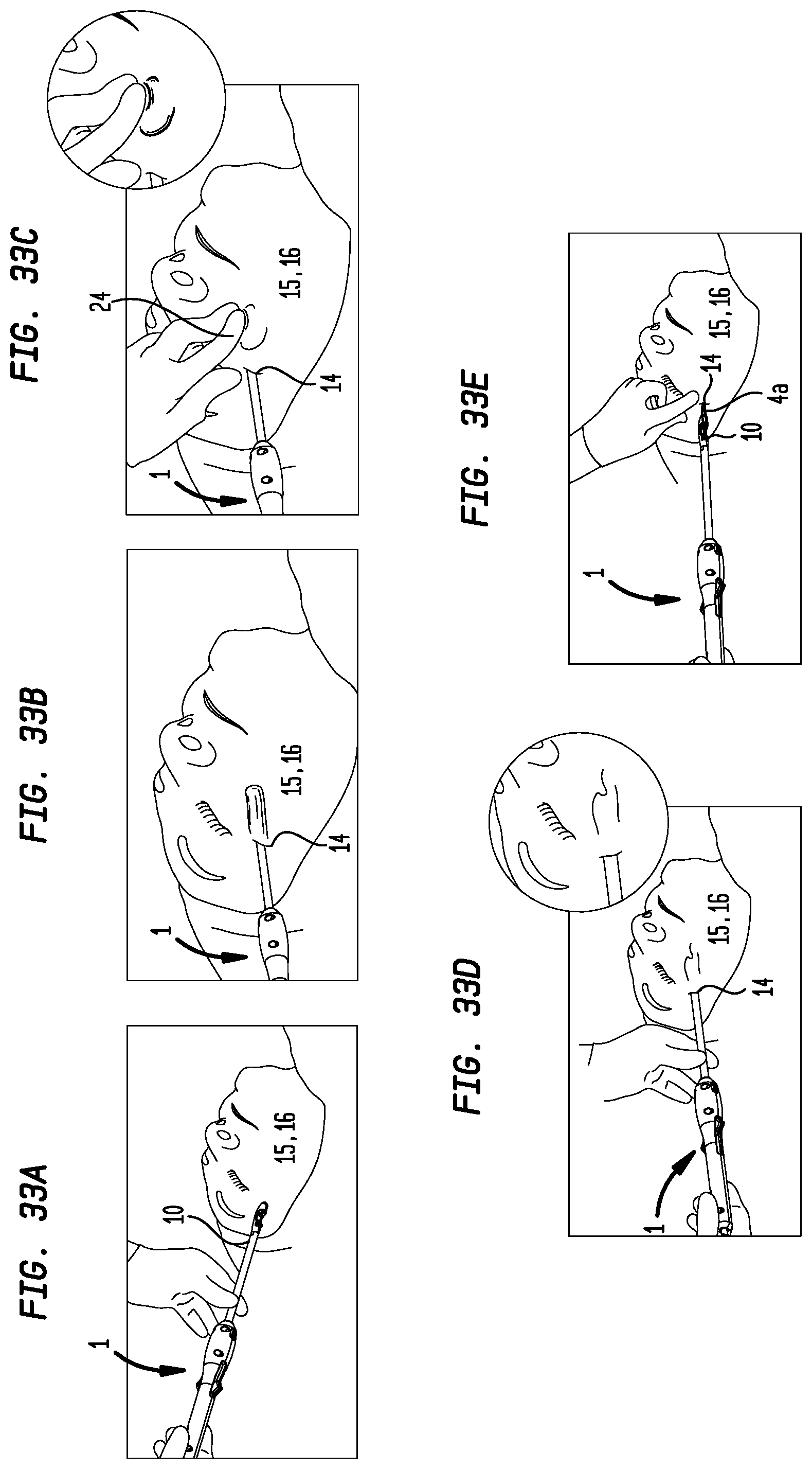 Patent US12137900 Figure 15 – Suture system