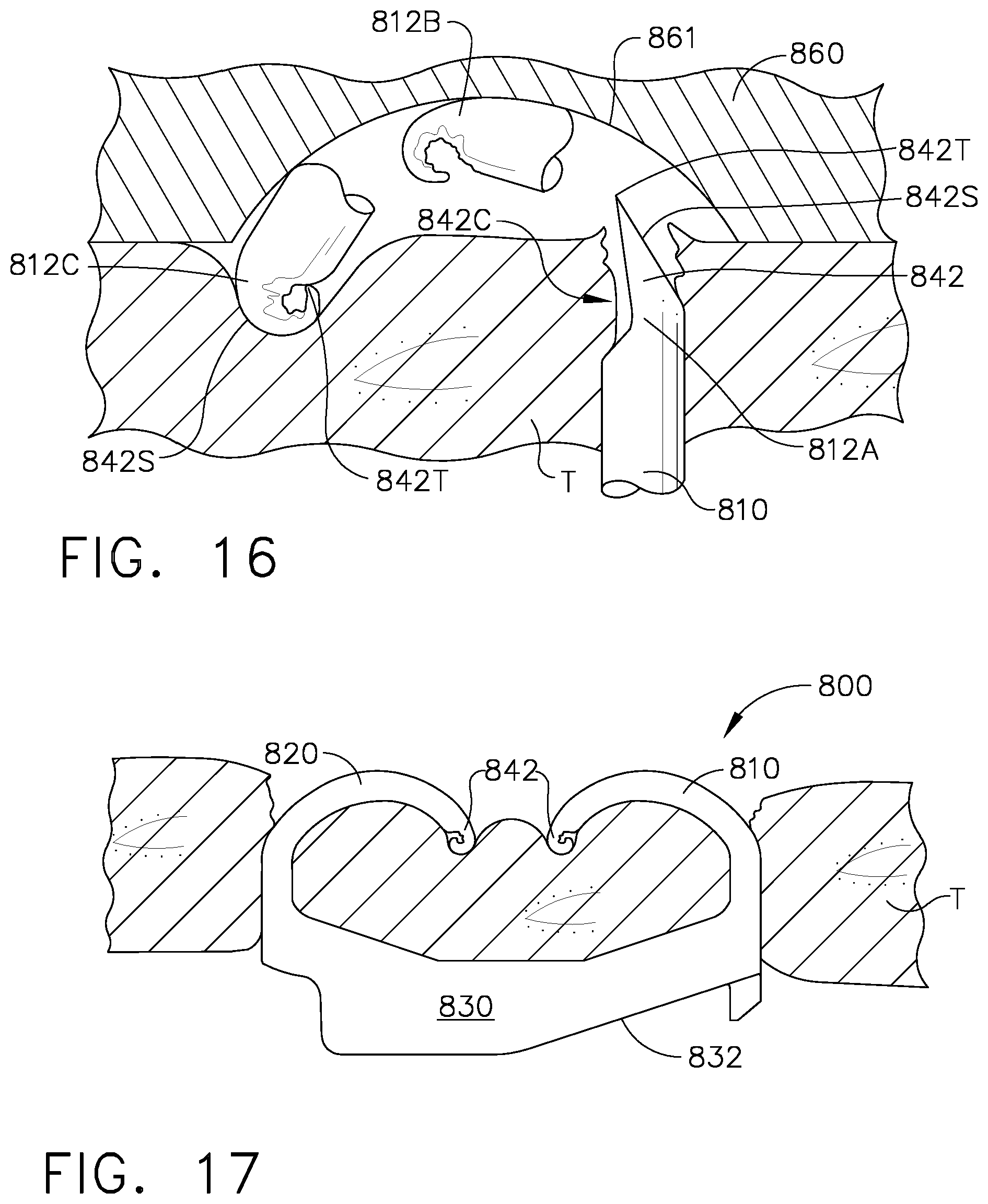 Patent US12137913 Figure 10 – Staple cartridge assembly comprising various tissue compression gaps and staple forming gaps