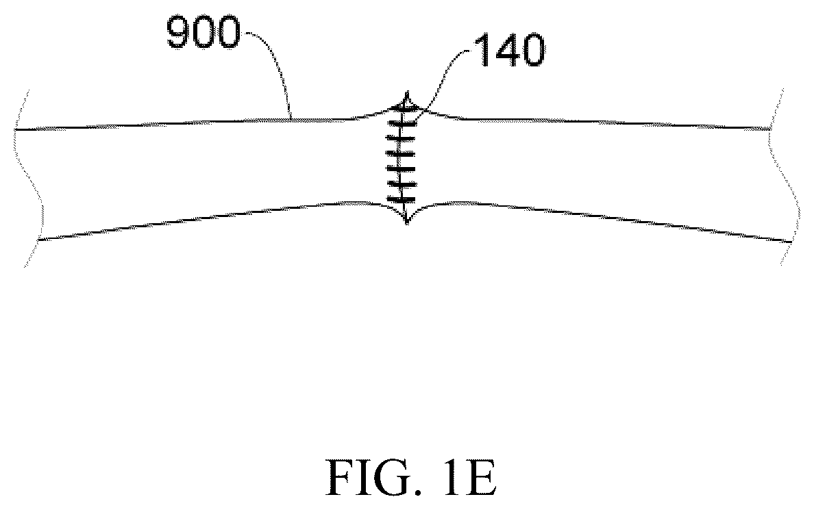 Patent US12137914 Figure 5 – Anastomosis set, anastomotic auxiliary and the method thereof