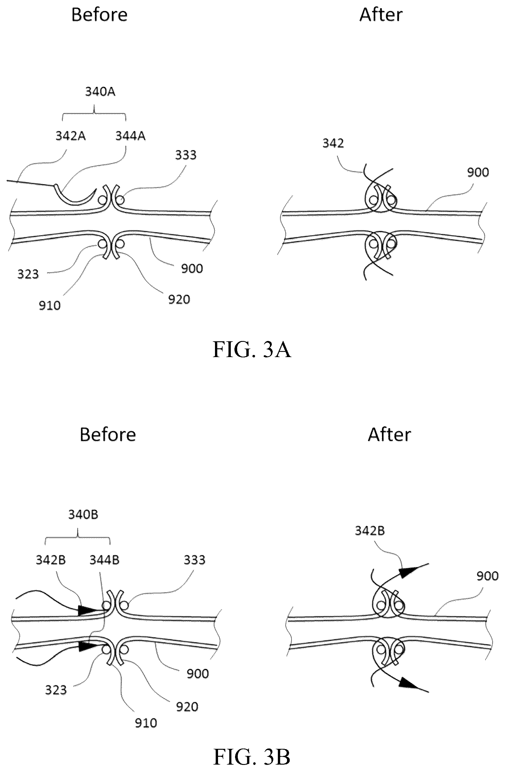 Patent US12137914 Figure 8 – Anastomosis set, anastomotic auxiliary and the method thereof