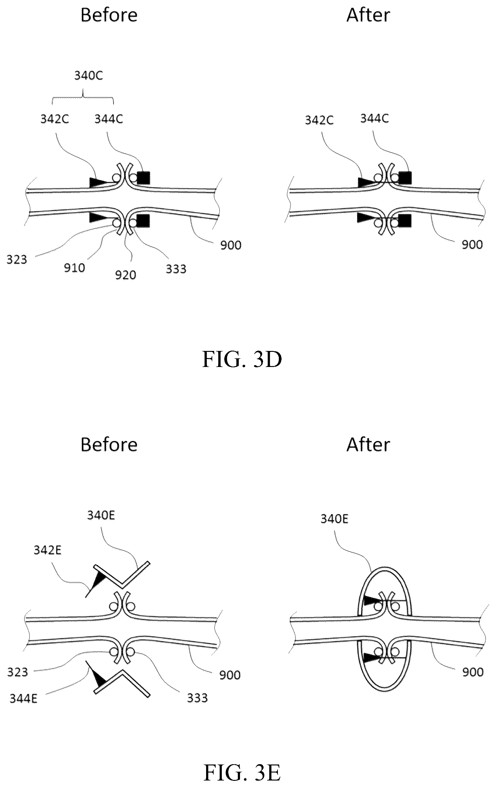 Patent US12137914 Figure 10 – Anastomosis set, anastomotic auxiliary and the method thereof
