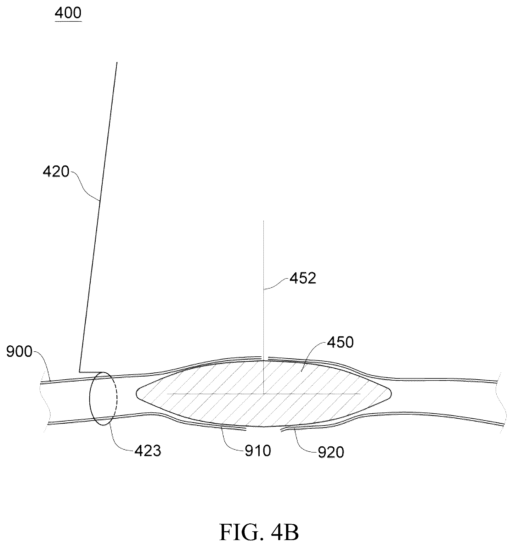 Patent US12137914 Figure 12 – Anastomosis set, anastomotic auxiliary and the method thereof