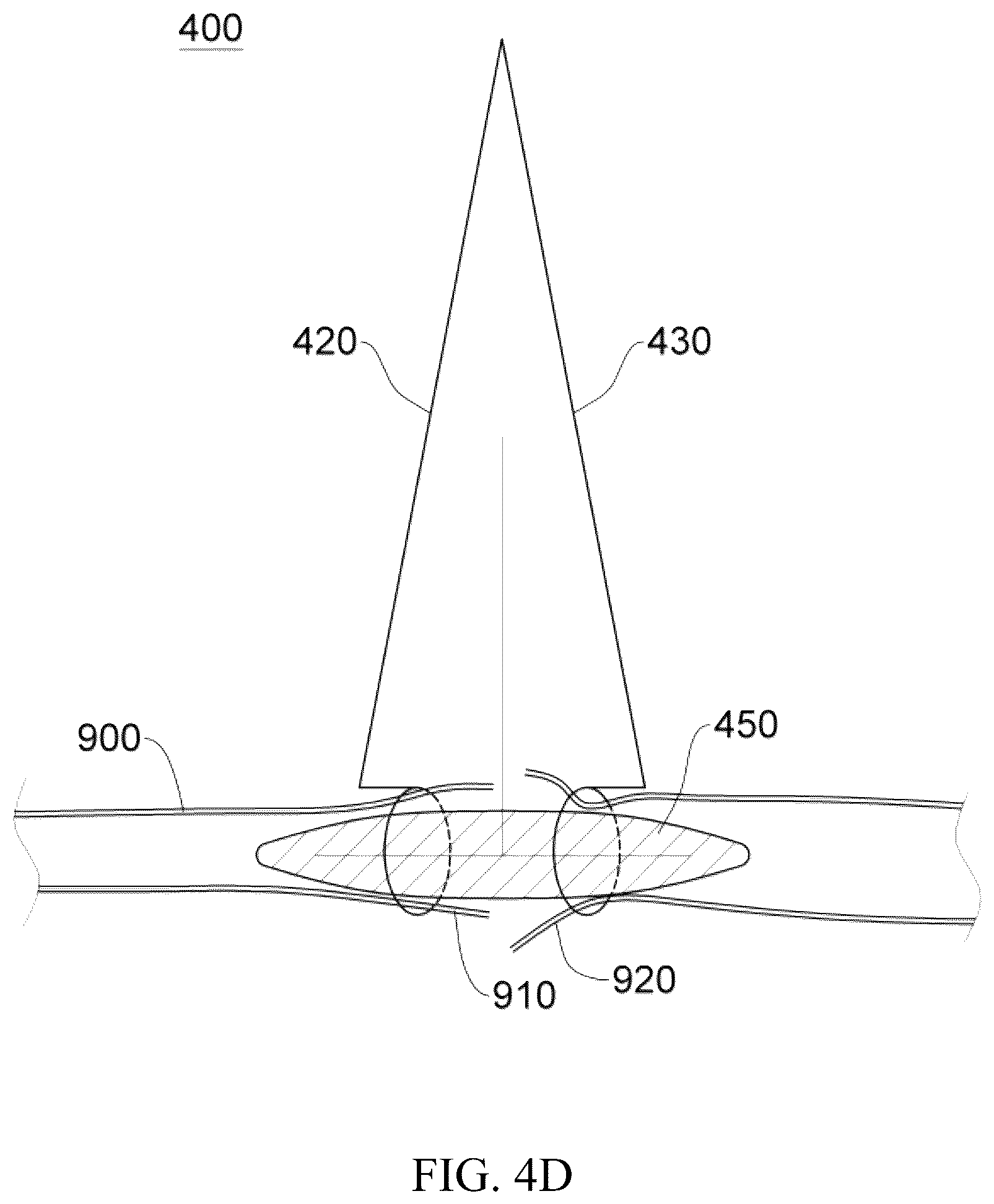 Patent US12137914 Figure 14 – Anastomosis set, anastomotic auxiliary and the method thereof