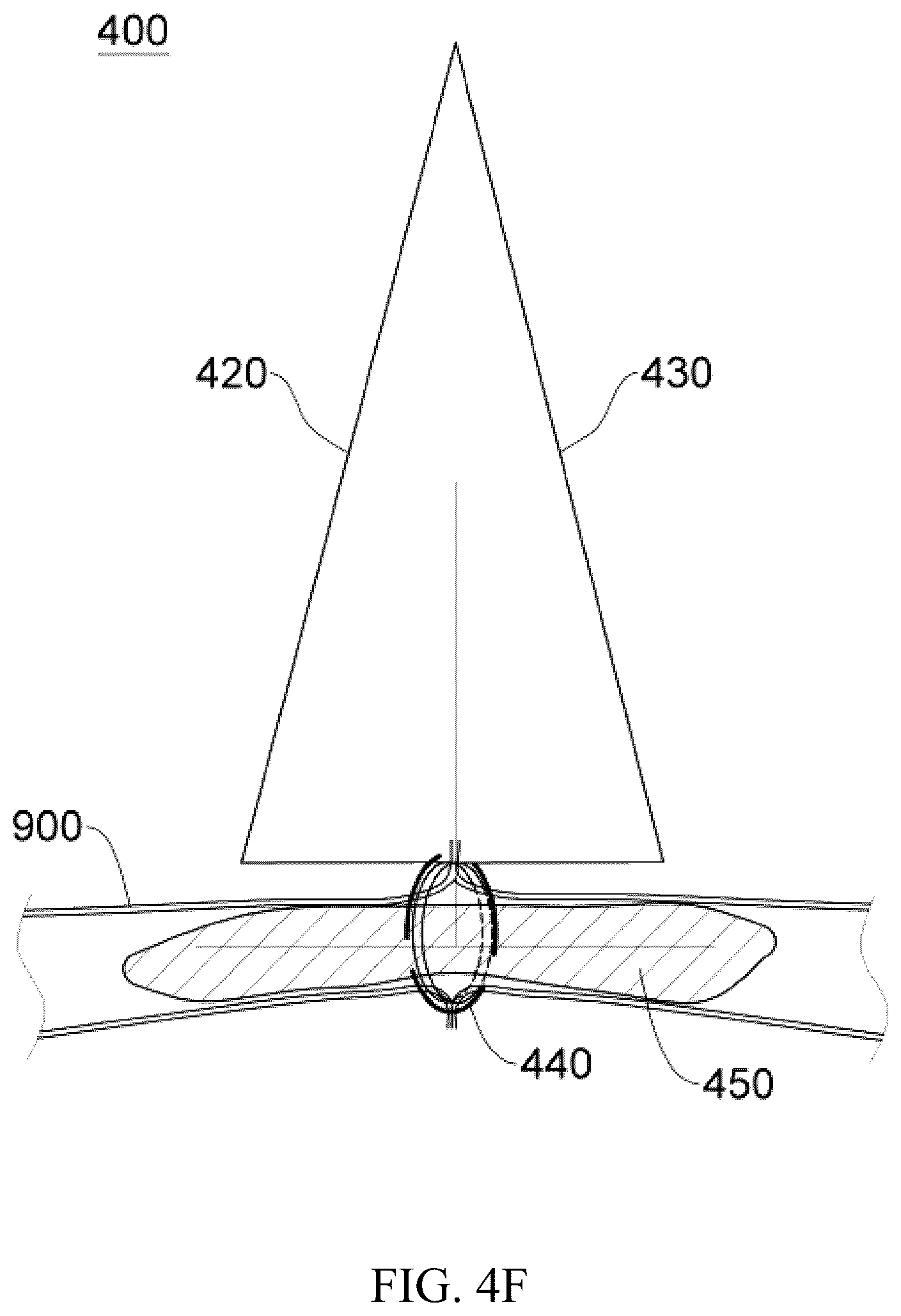 Patent US12137914 Figure 16 – Anastomosis set, anastomotic auxiliary and the method thereof