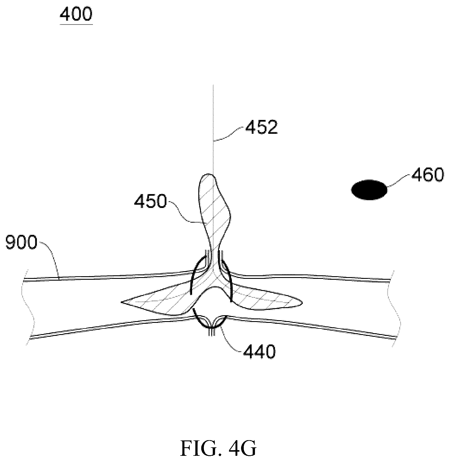 Patent US12137914 Figure 17 – Anastomosis set, anastomotic auxiliary and the method thereof