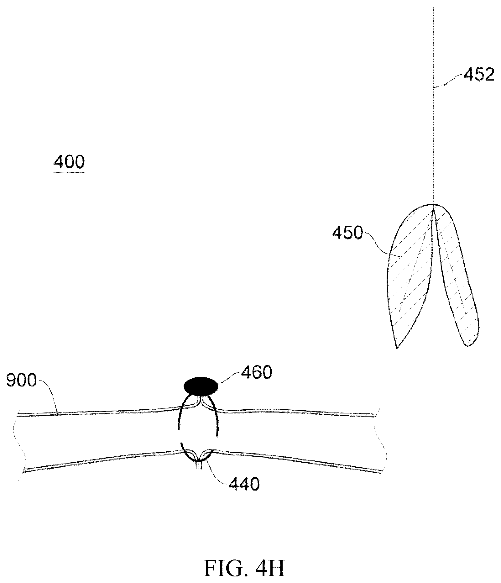 Patent US12137914 Figure 18 – Anastomosis set, anastomotic auxiliary and the method thereof
