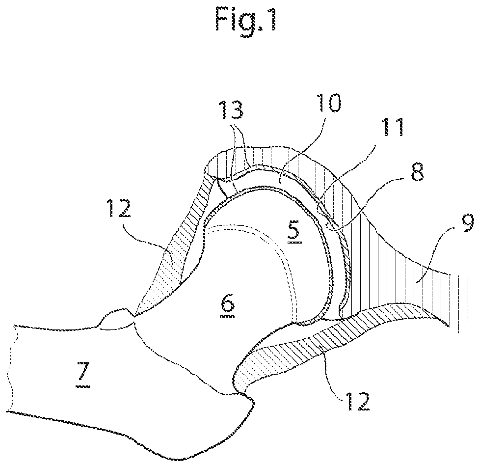Patent US12137920 — Medical device and method for treatment of hip joint — Figure 1