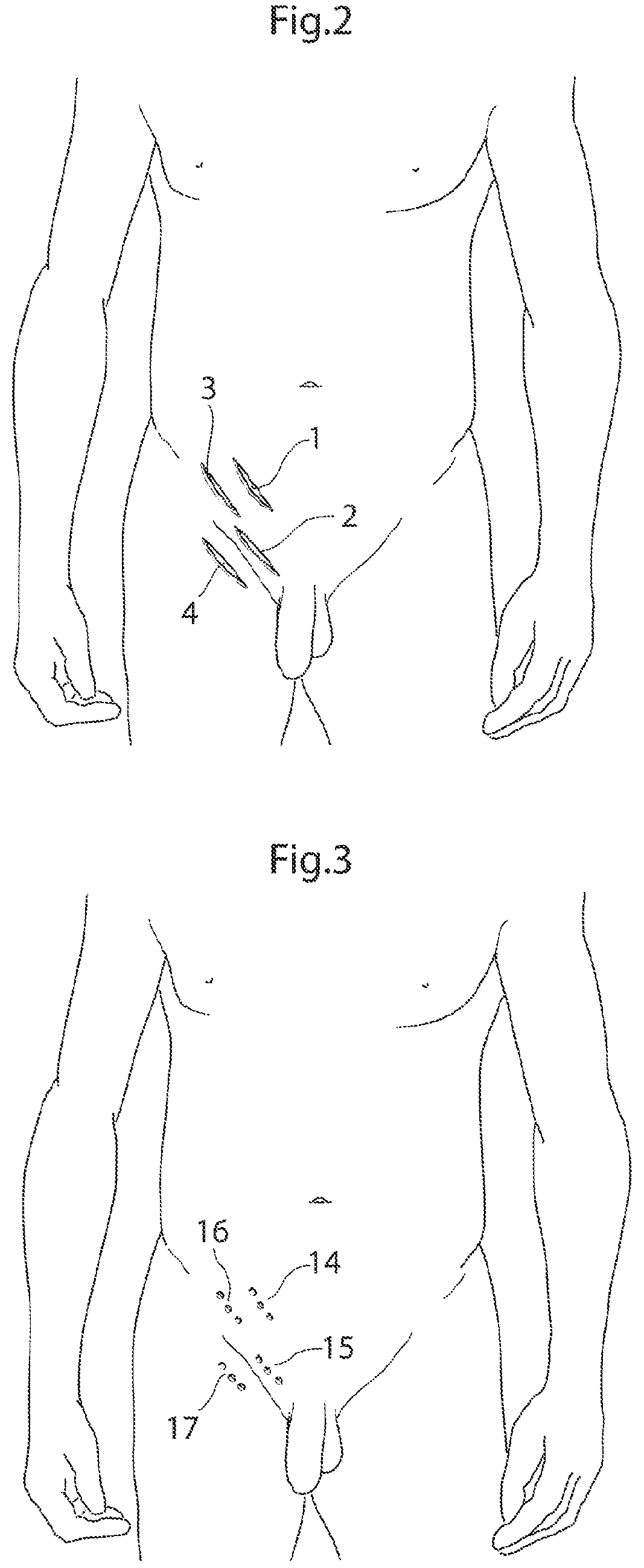 Patent US12137920 Figure 2 – Medical device and method for treatment of hip joint