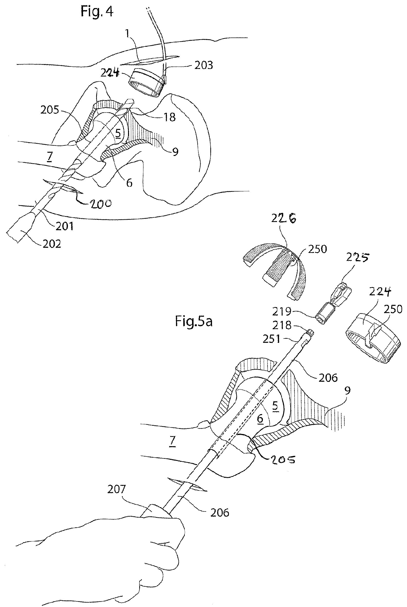 Patent US12137920 Figure 3 – Medical device and method for treatment of hip joint