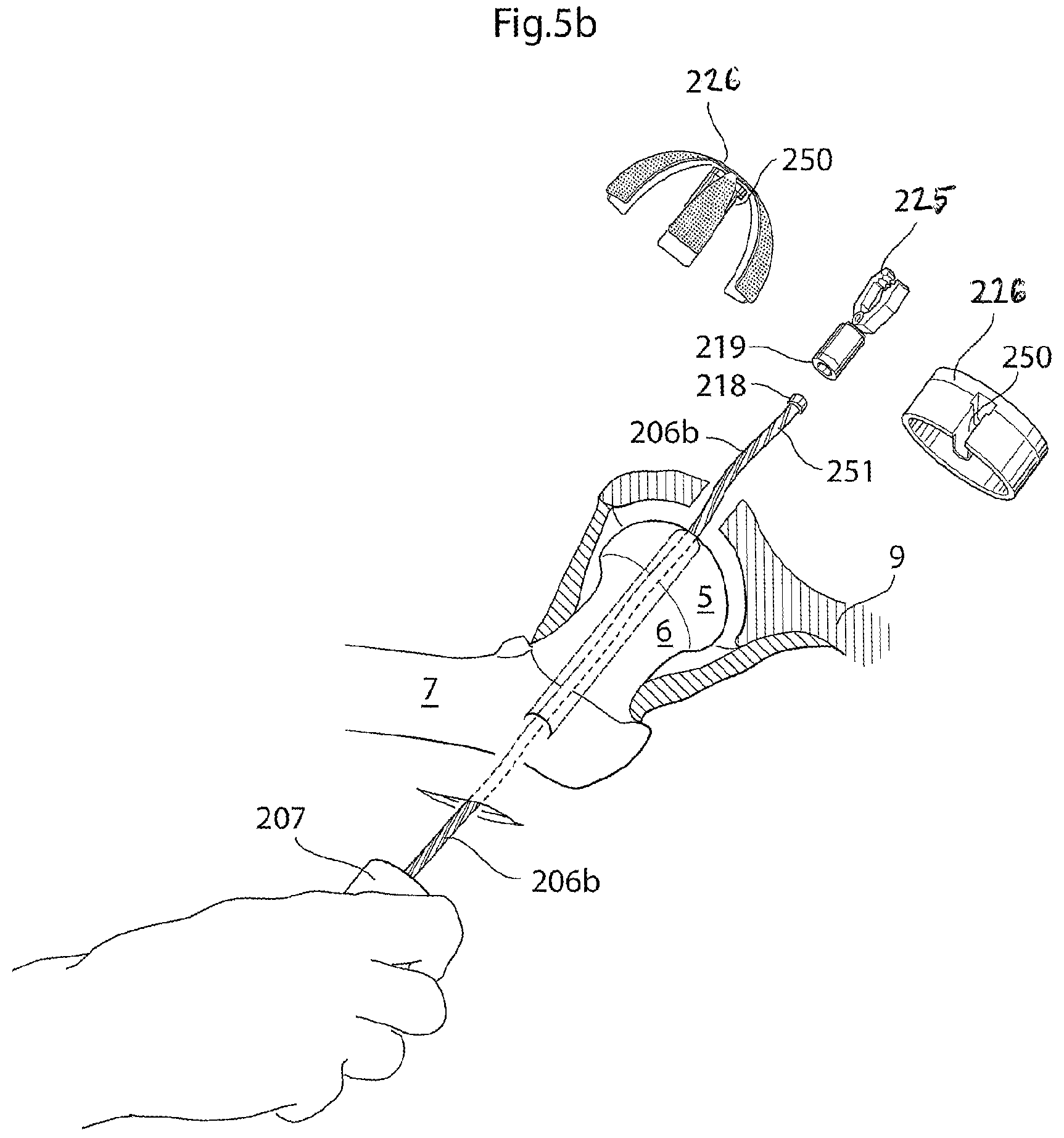 Patent US12137920 Figure 4 – Medical device and method for treatment of hip joint