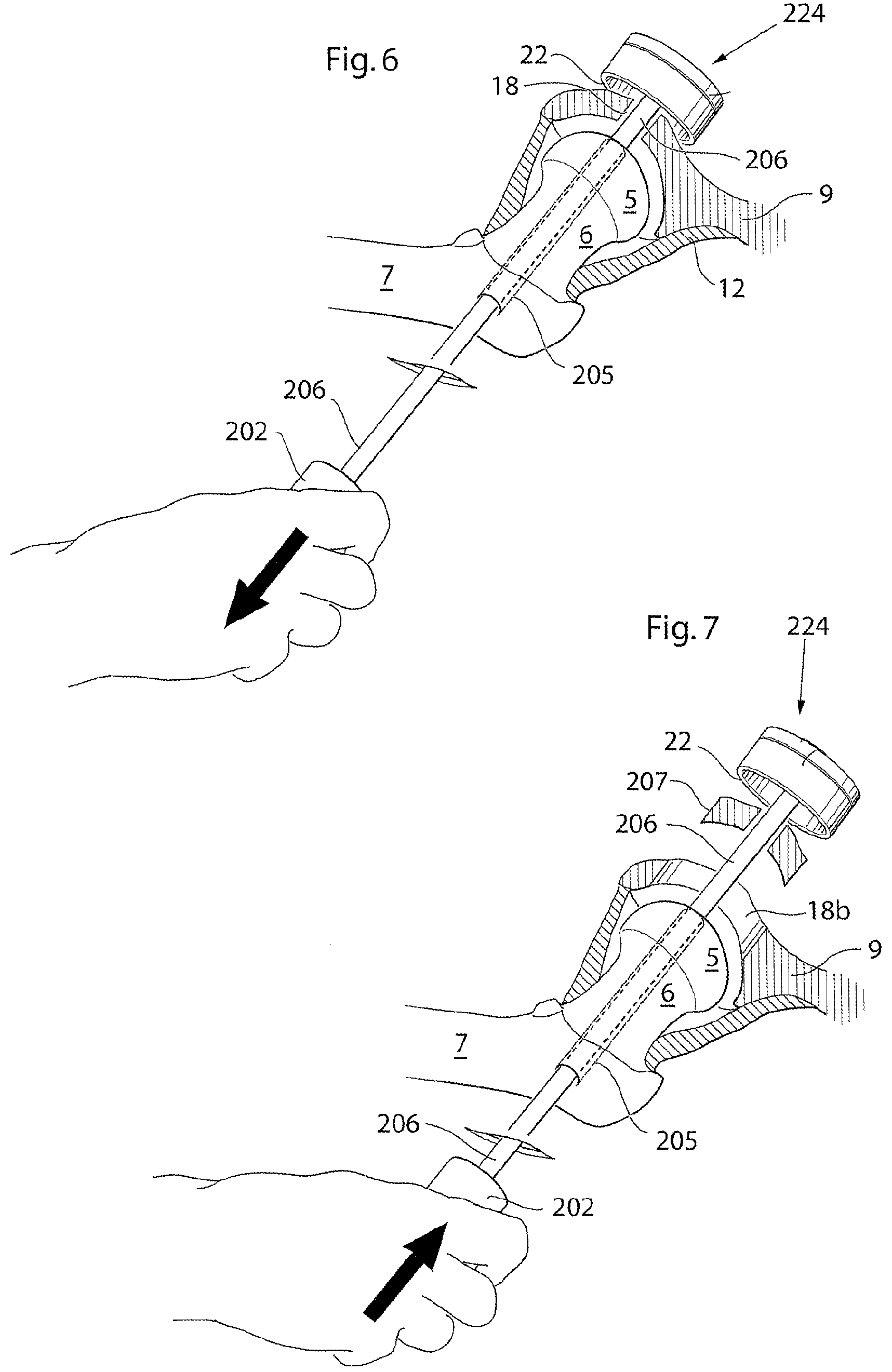 Patent US12137920 Figure 5 – Medical device and method for treatment of hip joint
