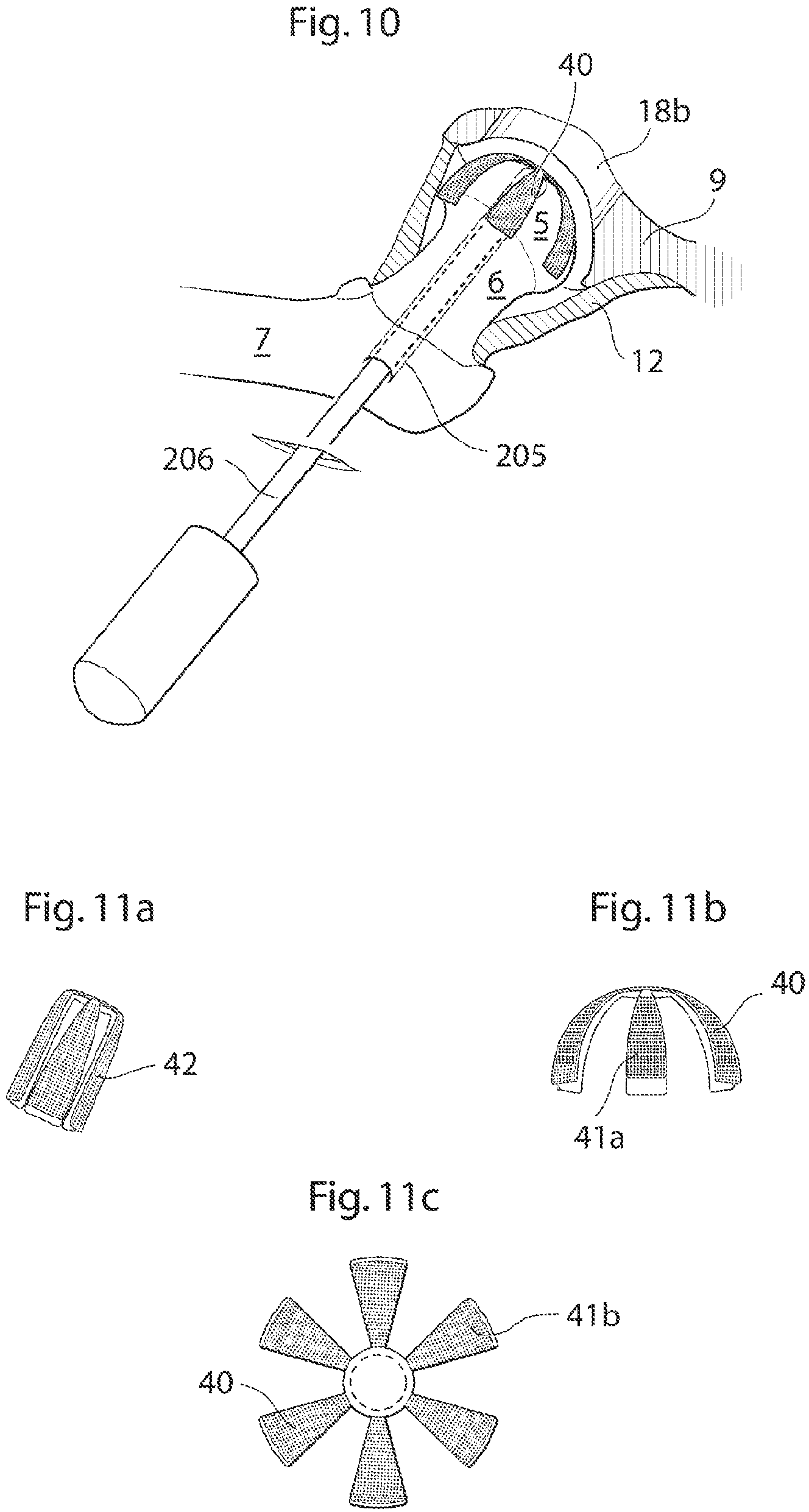Patent US12137920 Figure 7 – Medical device and method for treatment of hip joint